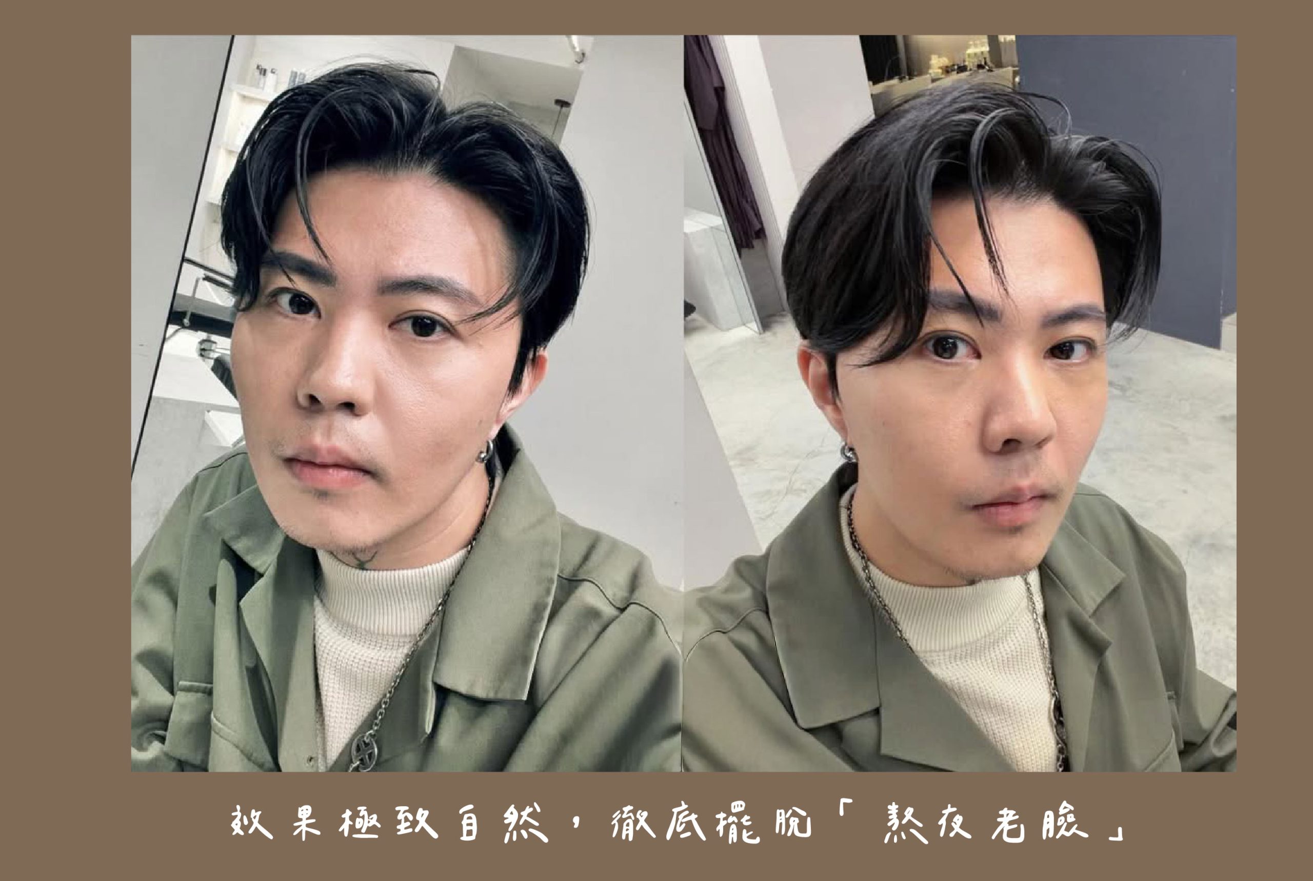 胡守丞醫師-瑞絲朗玻尿酸_術後2個禮拜