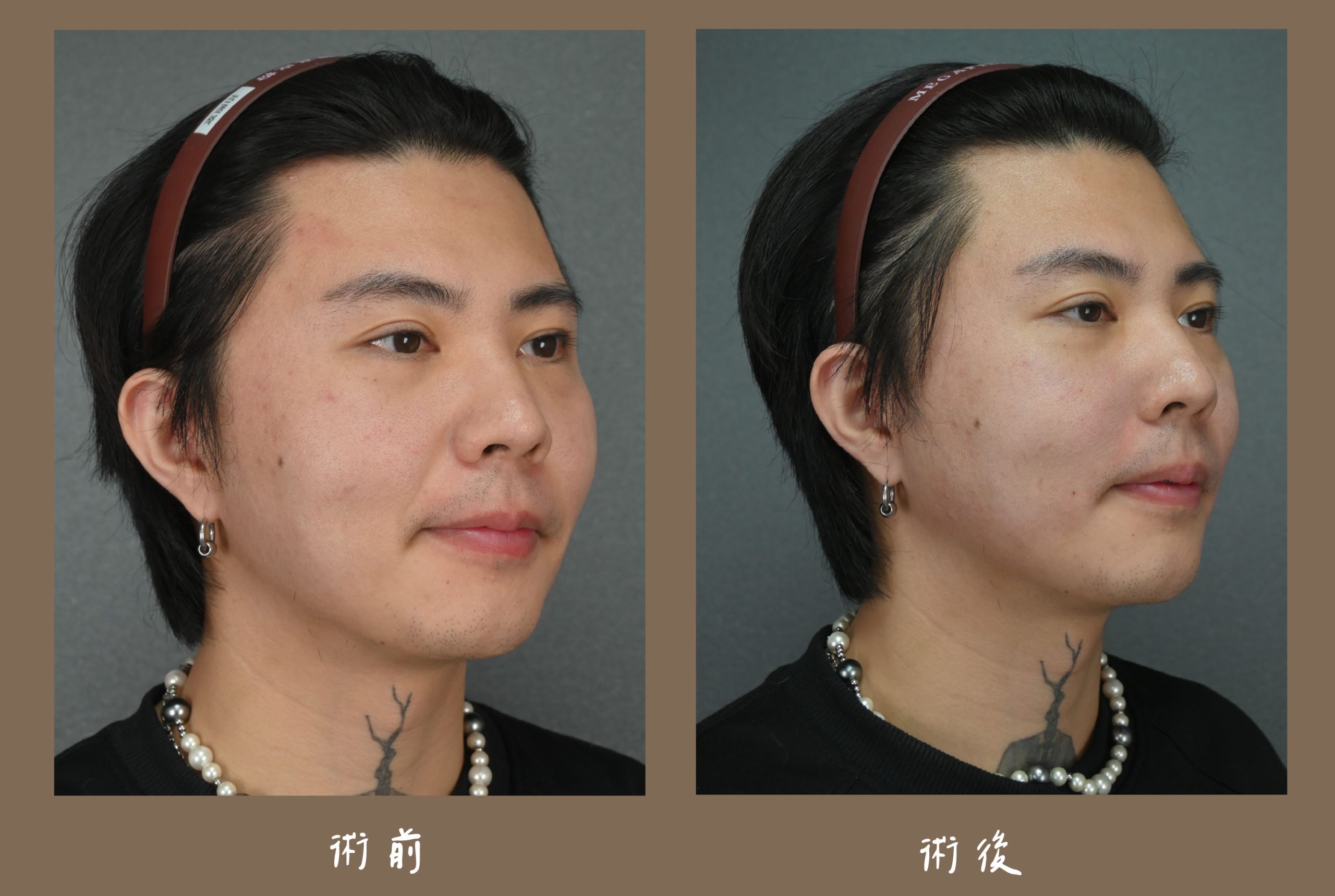 胡守丞院長-瑞絲朗玻尿酸_術前術後對比