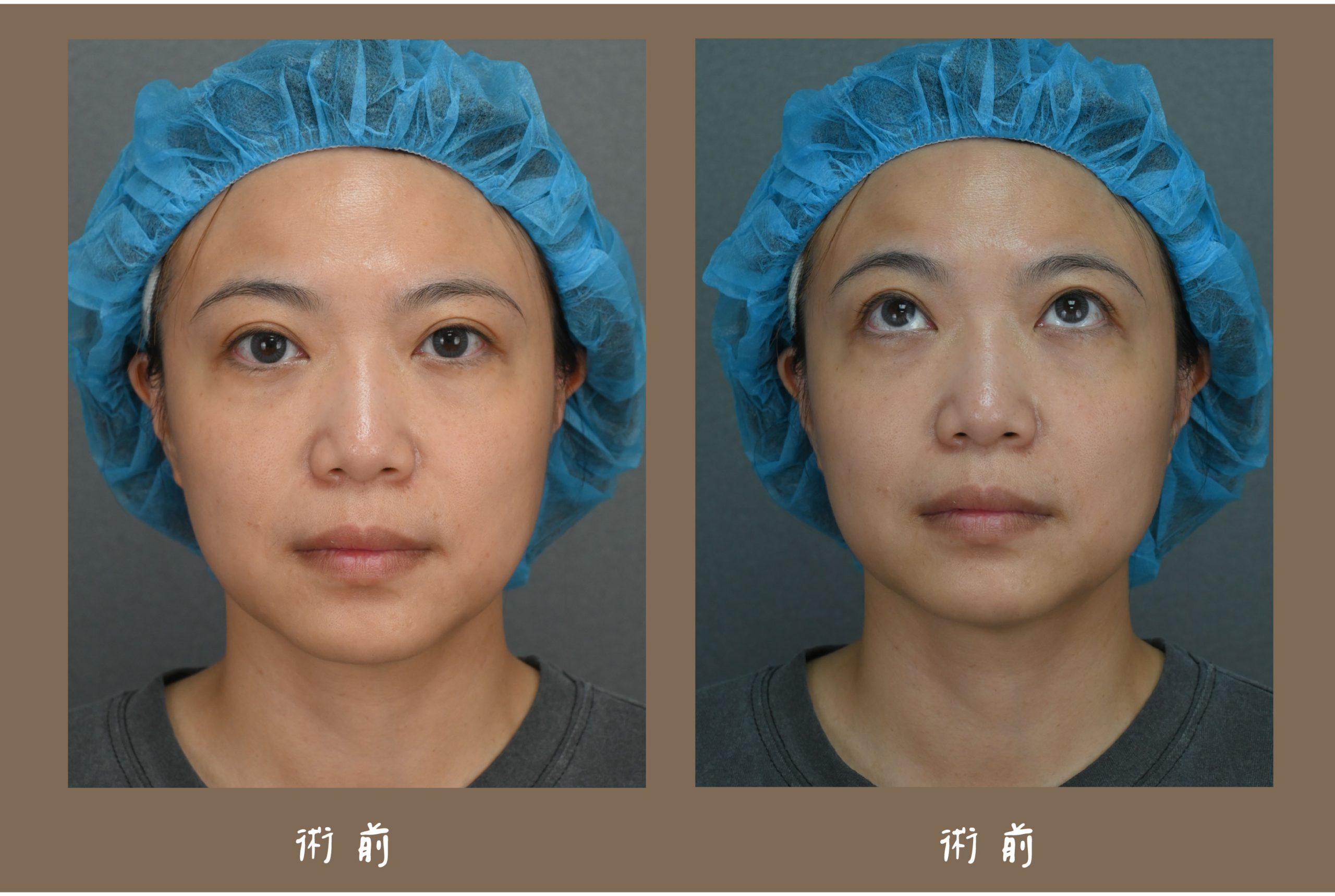 胡守丞醫師-複合式隱痕淚溝眼袋術前