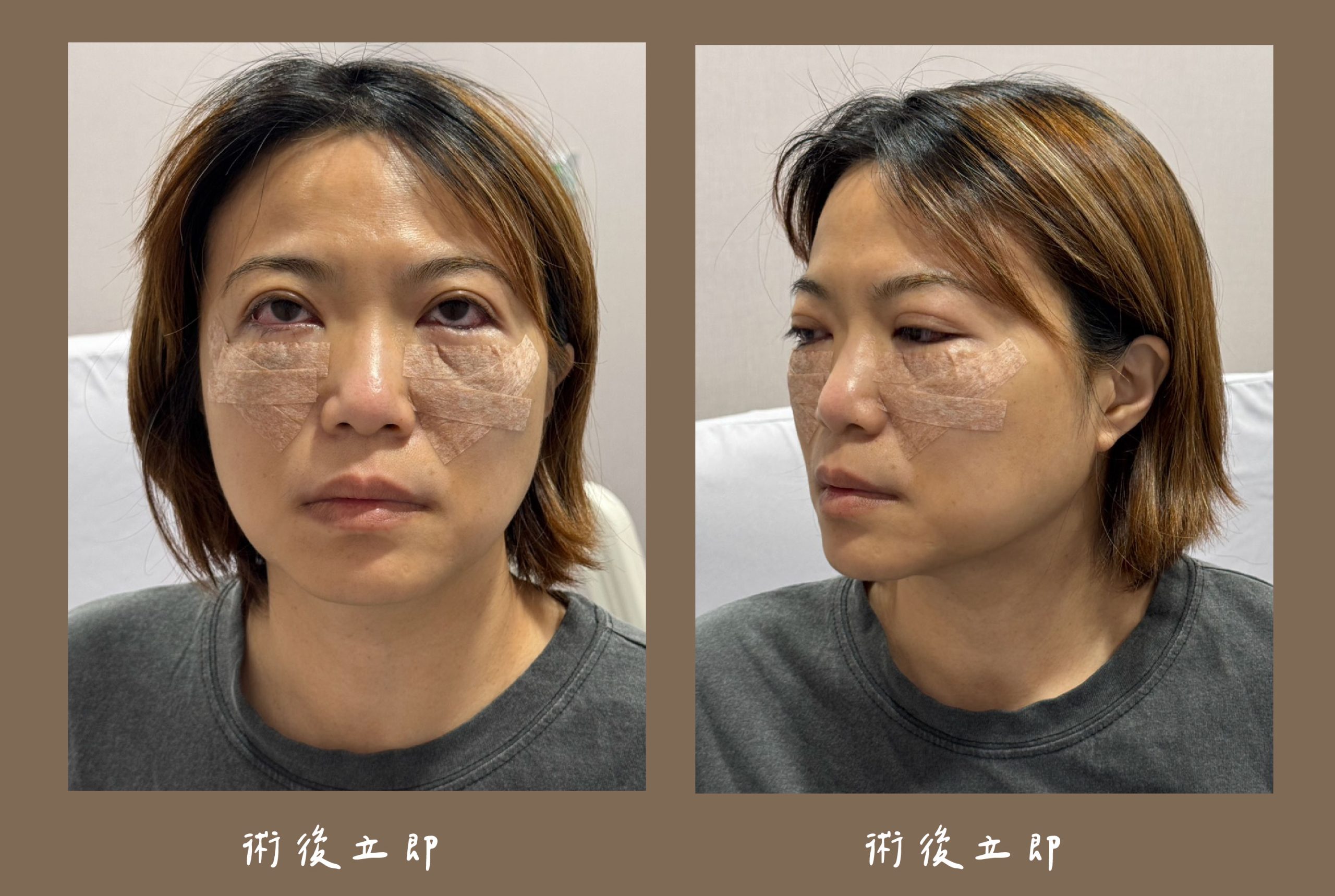 胡守丞醫師-複合式隱痕淚溝眼袋術後立即