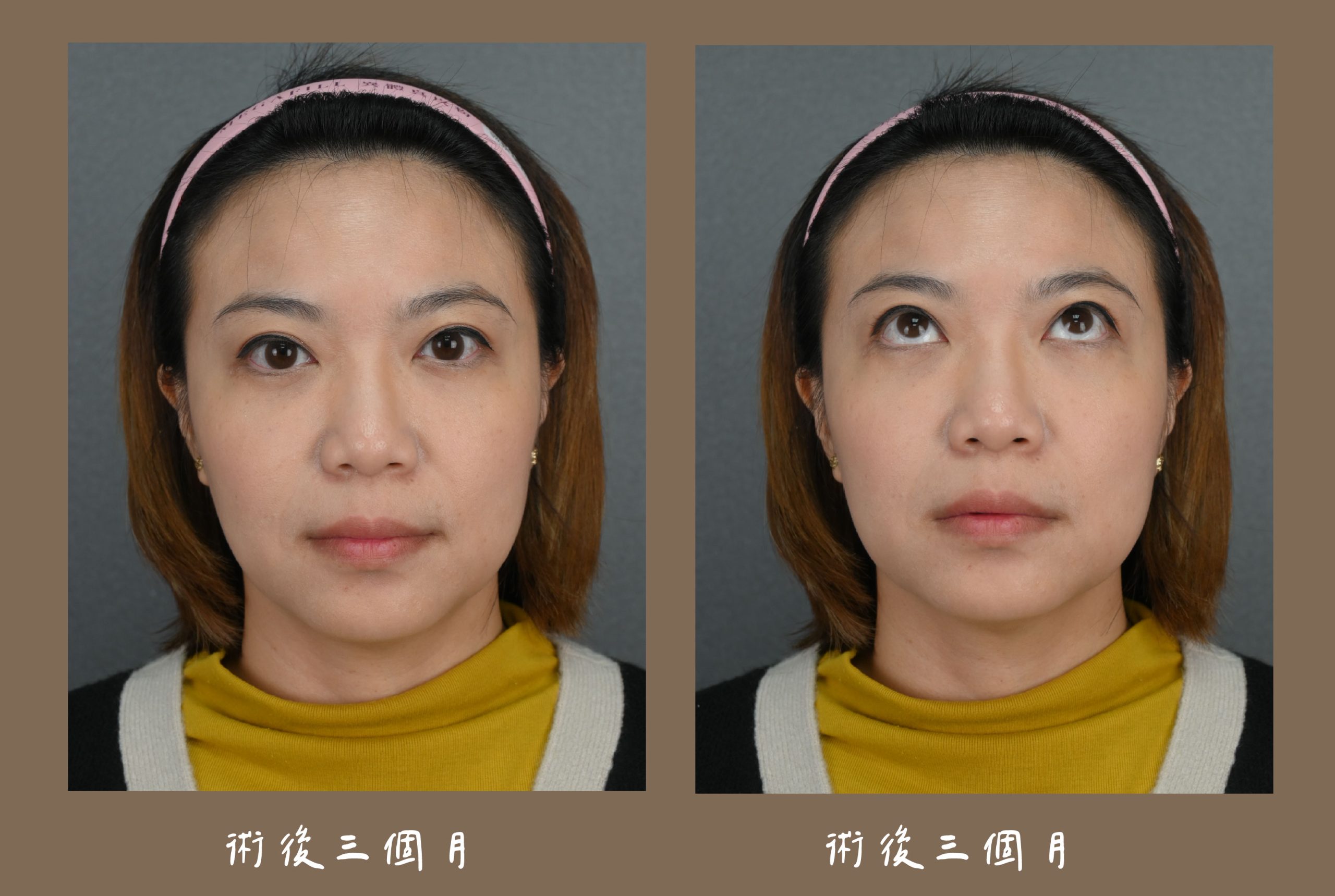 胡守丞醫師-複合式隱痕淚溝眼袋術後