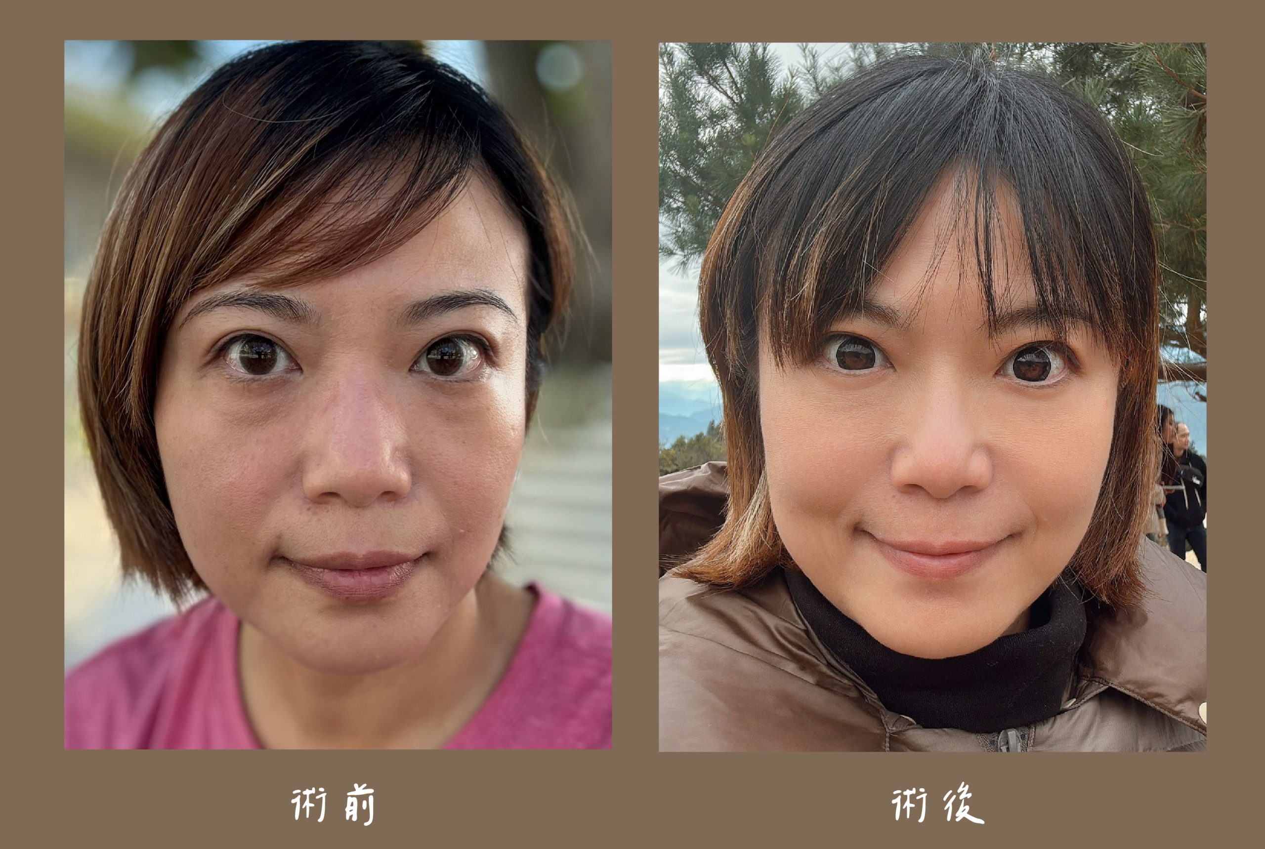 胡守丞醫師-複合式隱痕淚溝眼袋術後生活照