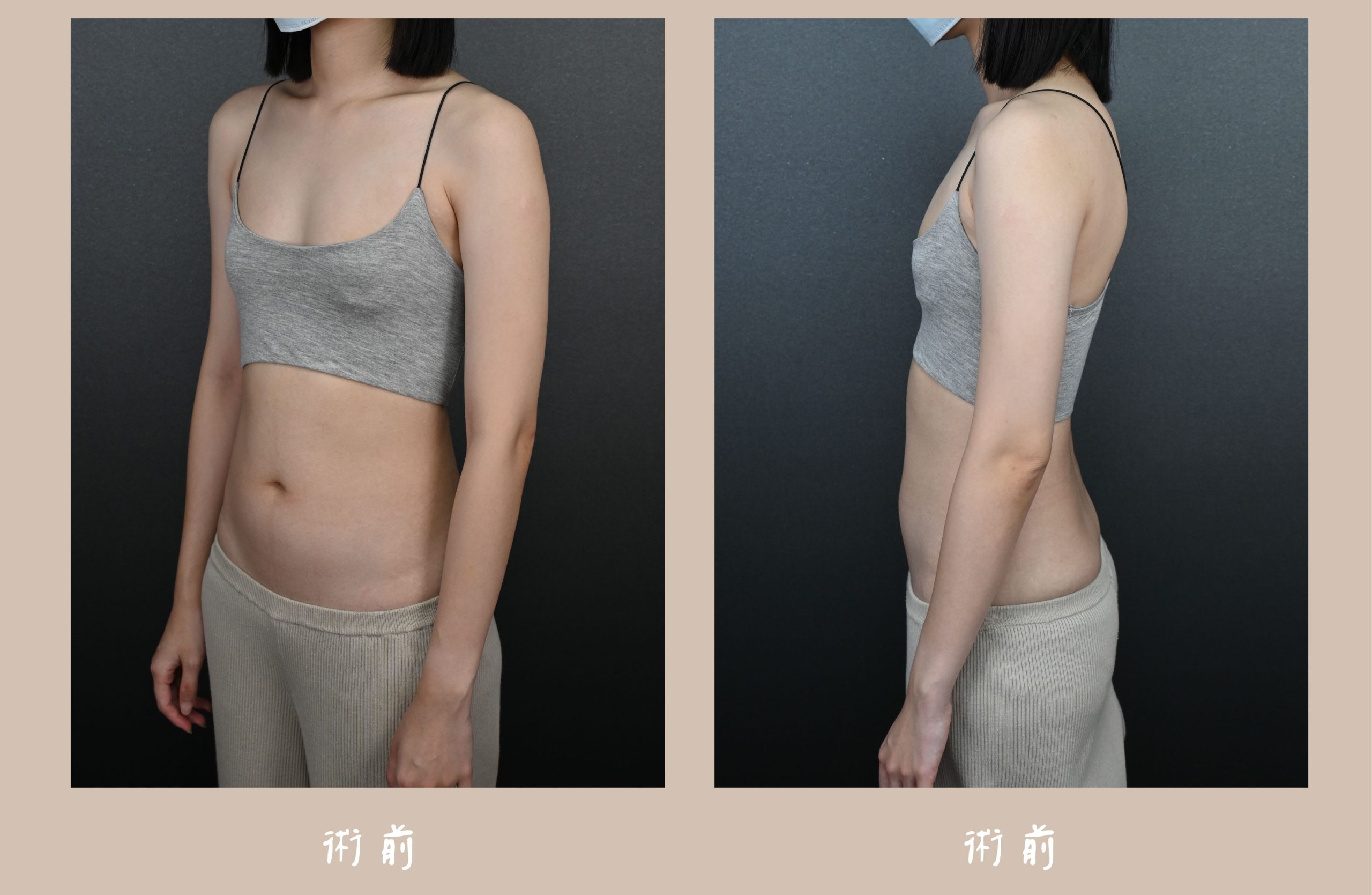 胡守丞院長-音浪脂雕術前