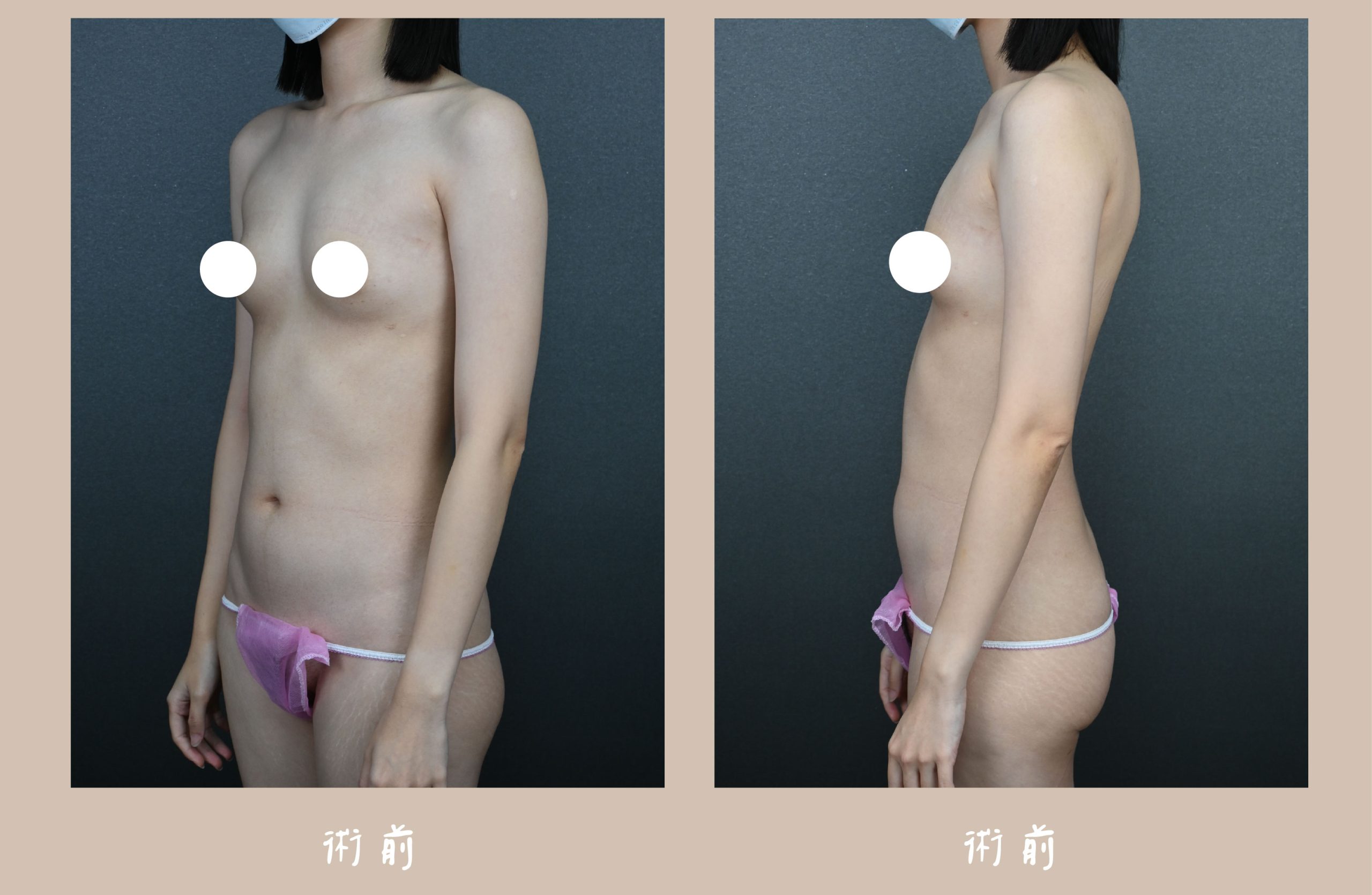 胡守丞院長-音浪脂雕術前