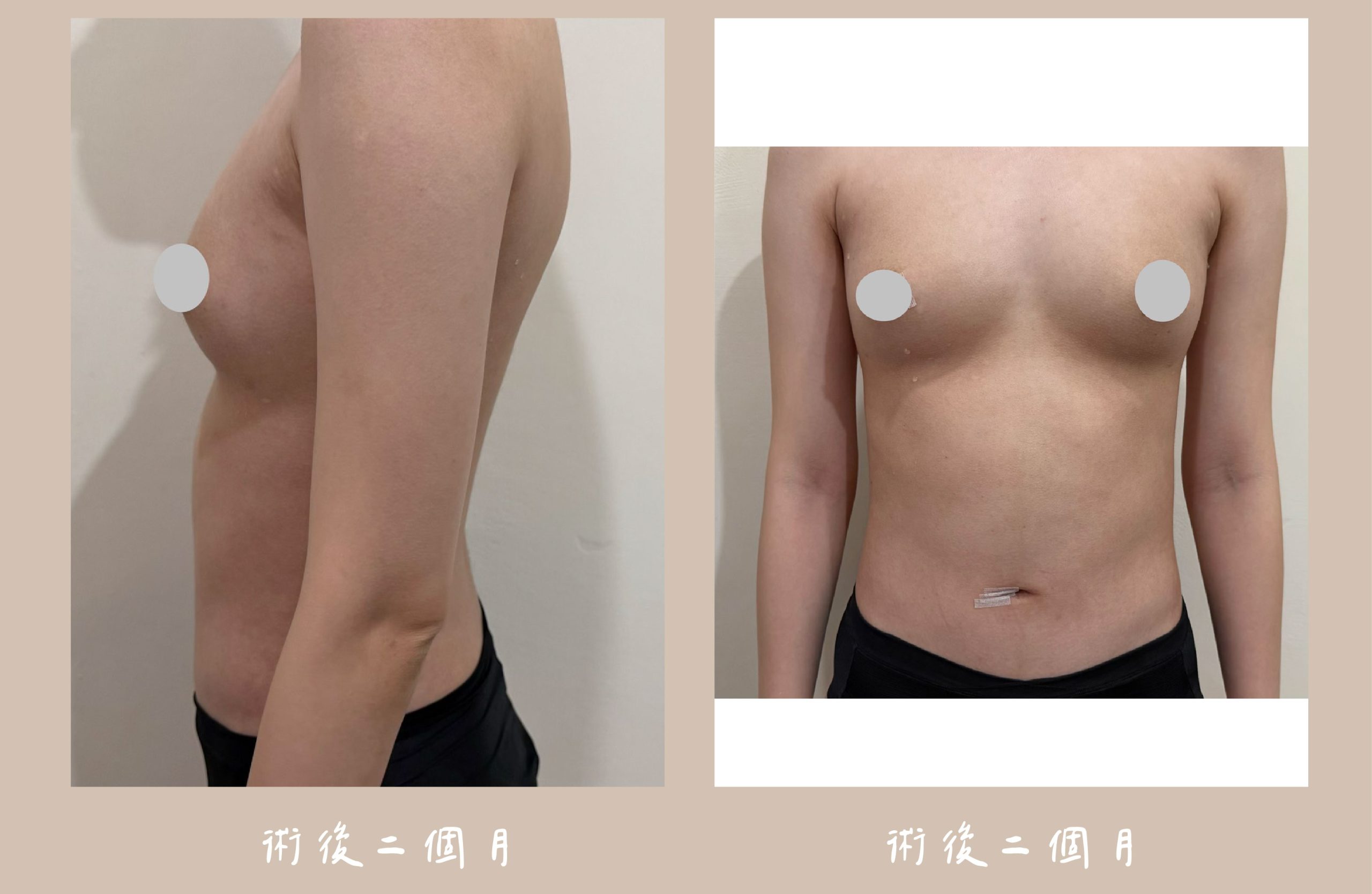 胡守丞院長-音浪脂雕術後2個月