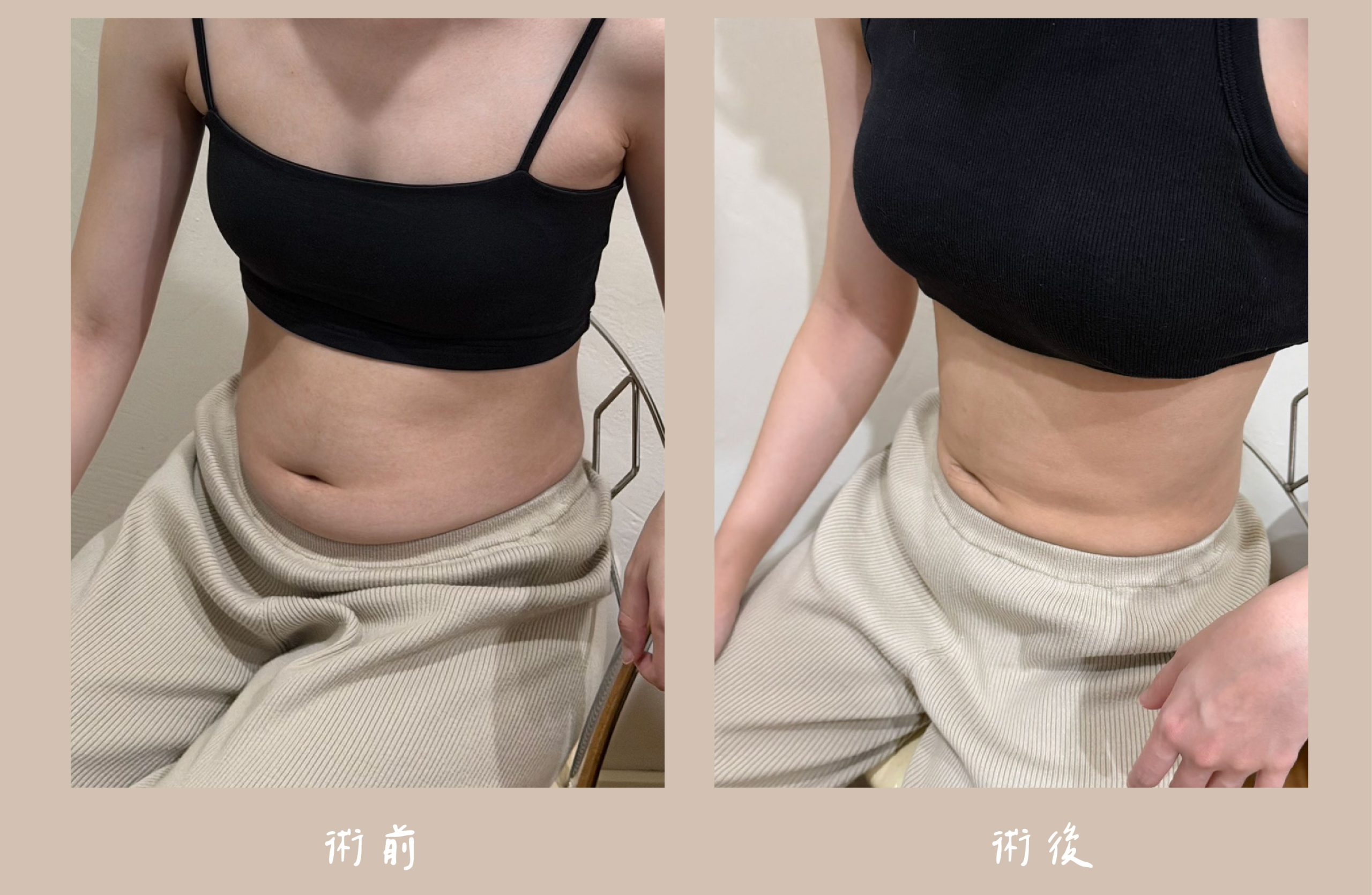 胡守丞院長-音浪脂雕術前術後對比