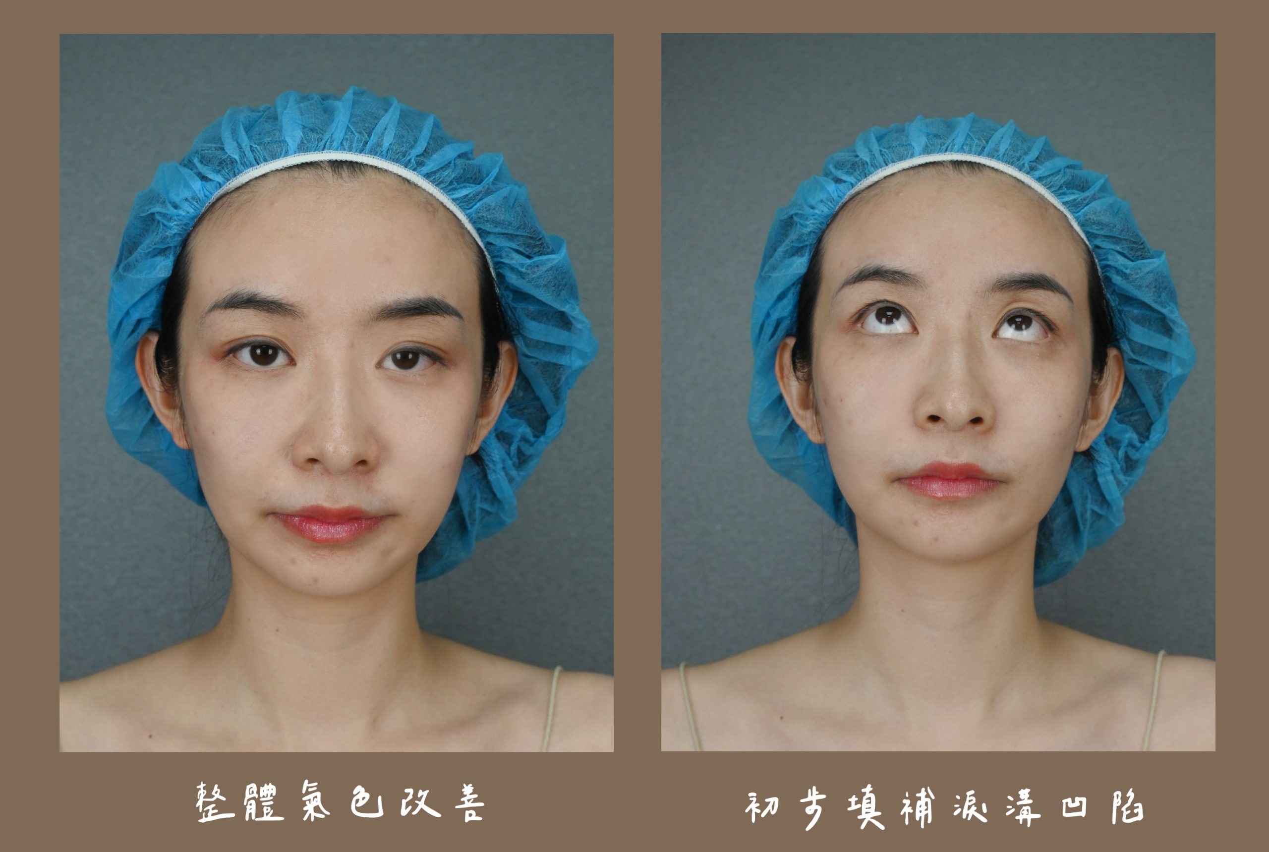 胡守丞醫師-薇貝拉-白童_術後立即