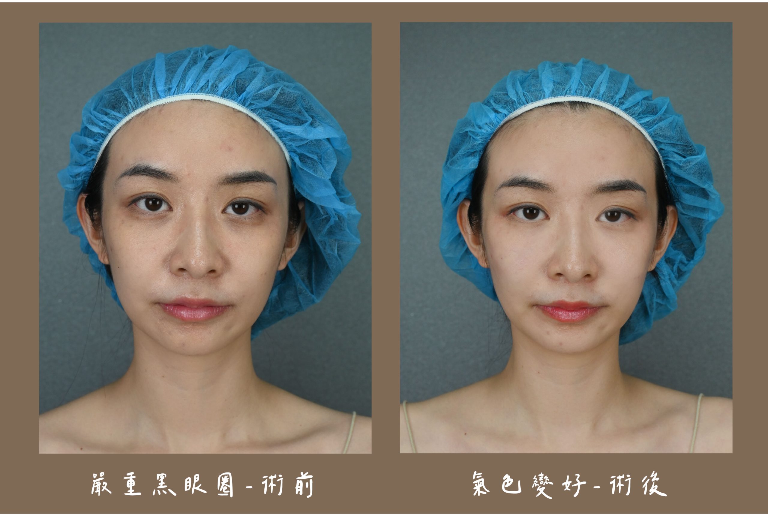 胡守丞院長-薇貝拉-白童前術後對比