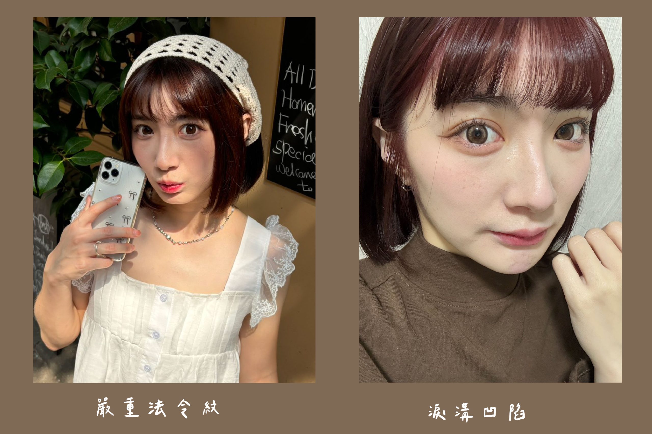 胡守丞醫師-薇貝拉-瑞斯朗玻尿酸_術前