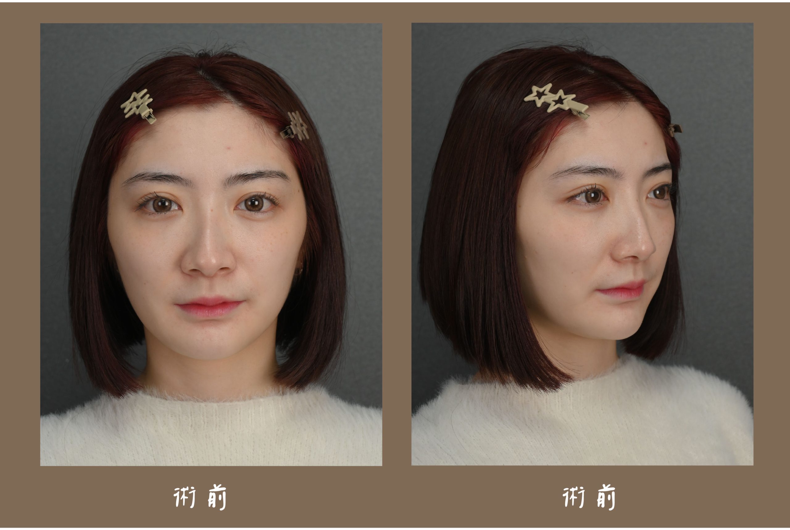 胡守丞醫師-薇貝拉-瑞斯朗玻尿酸_術前