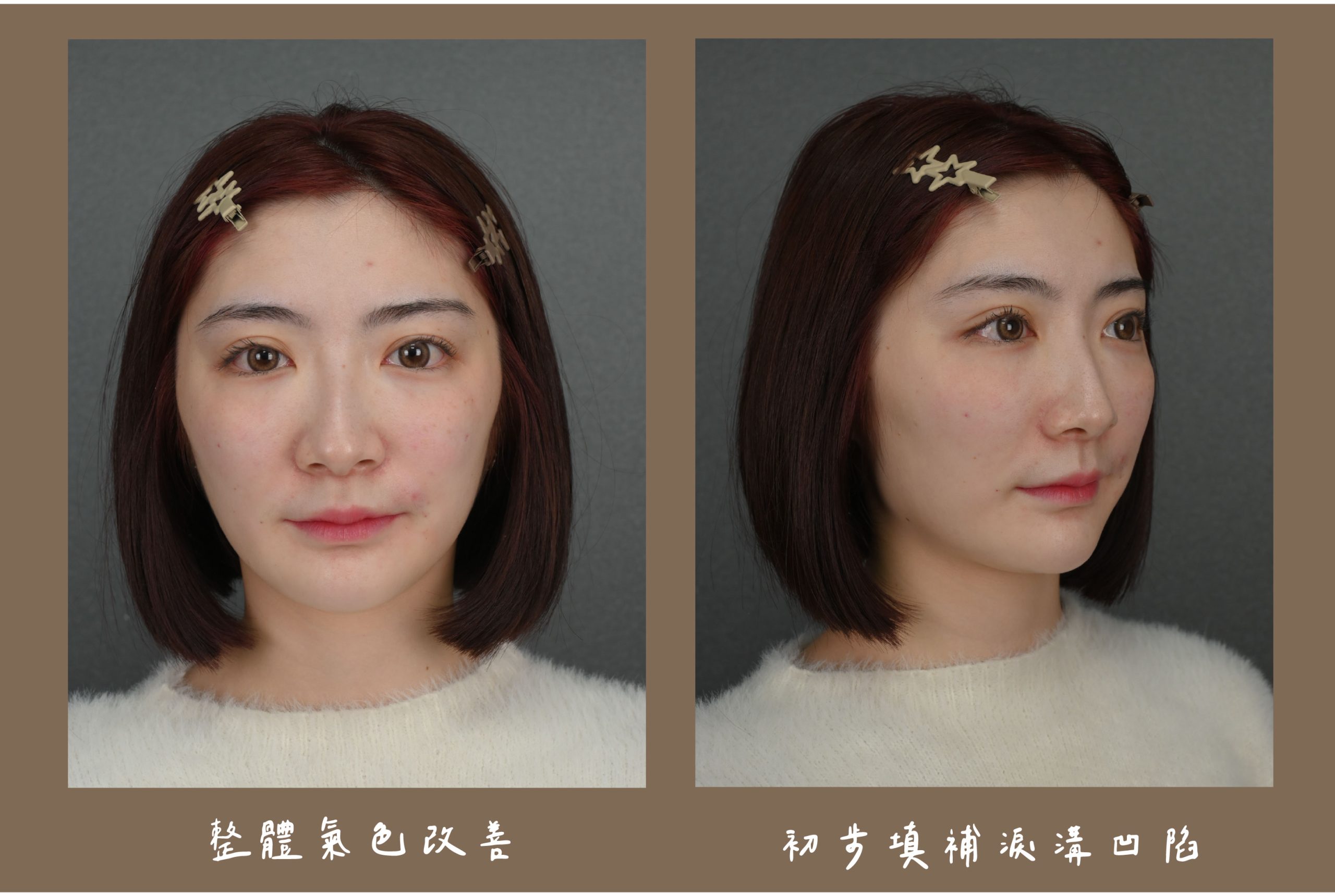 胡守丞醫師-薇貝拉-瑞斯朗玻尿酸_術後立即