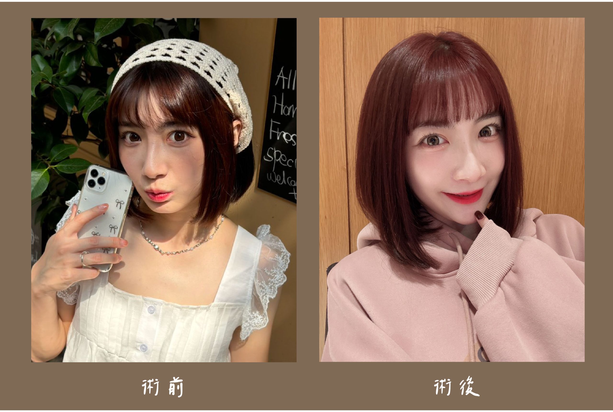 胡守丞院長-薇貝拉+瑞斯朗玻尿酸術前術後對比