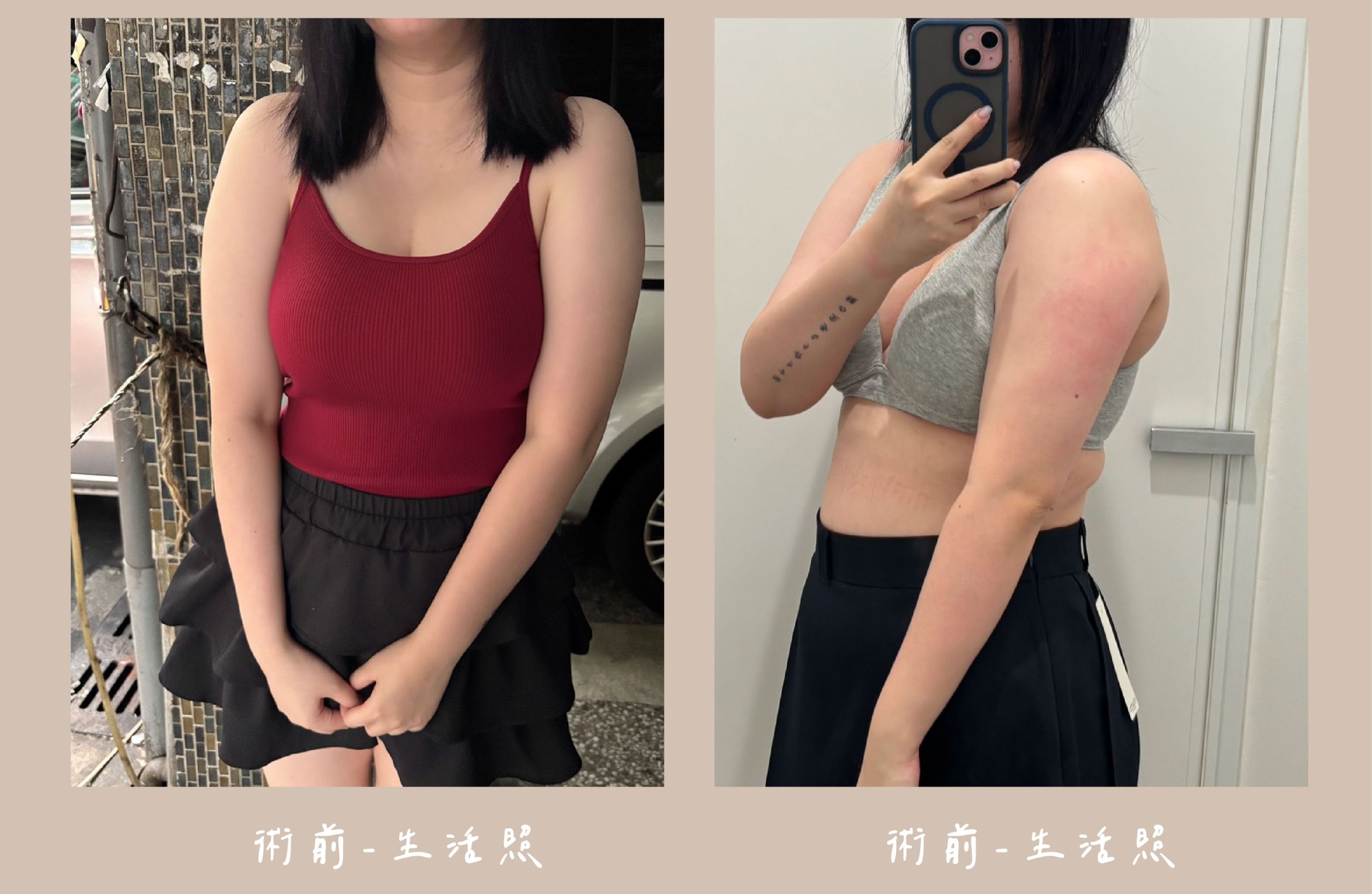 胡守丞院長-威塑2.2抽脂術前生活照