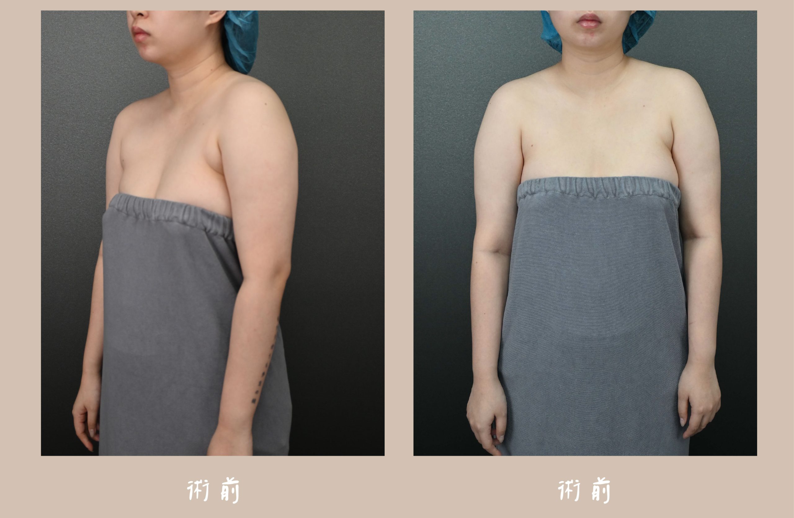 胡守丞院長-威塑2.2抽脂手臂環抽術前