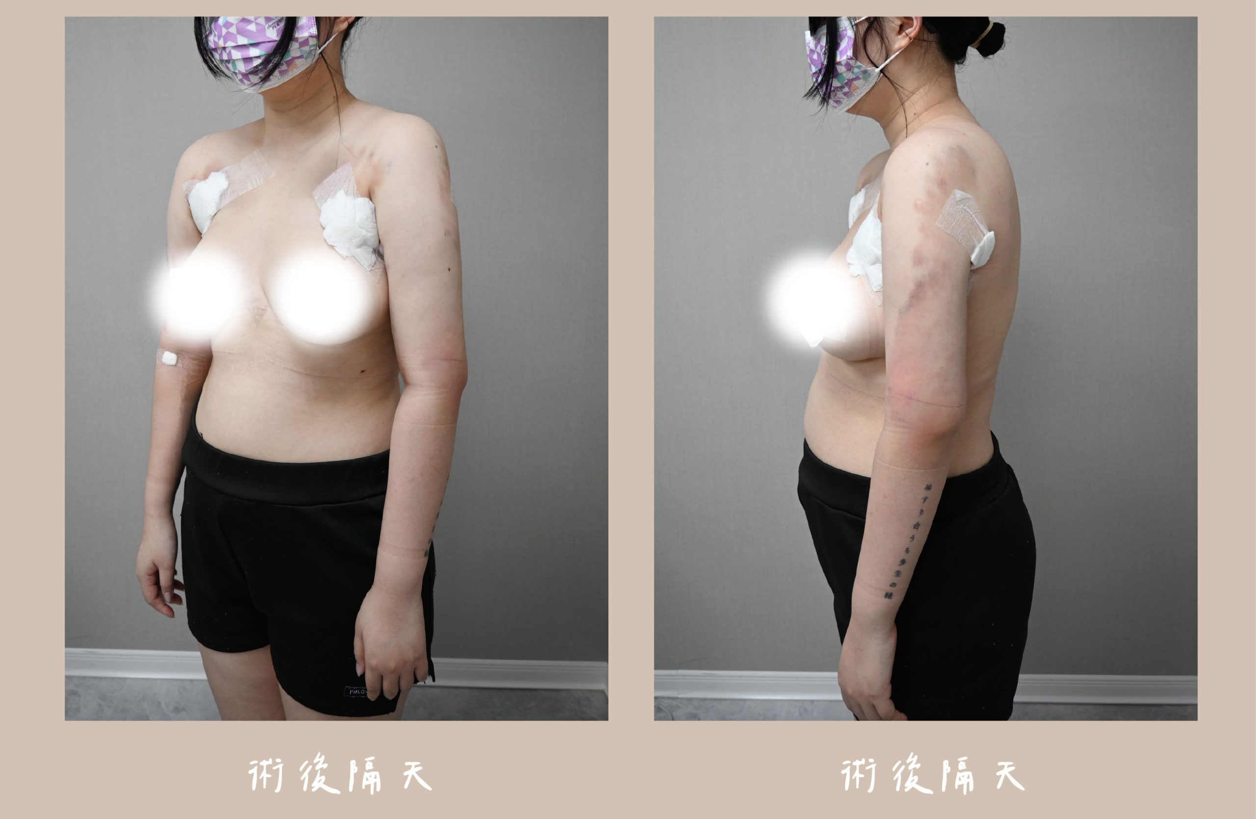 胡守丞院長-威塑2.2抽脂手臂環抽術後隔天