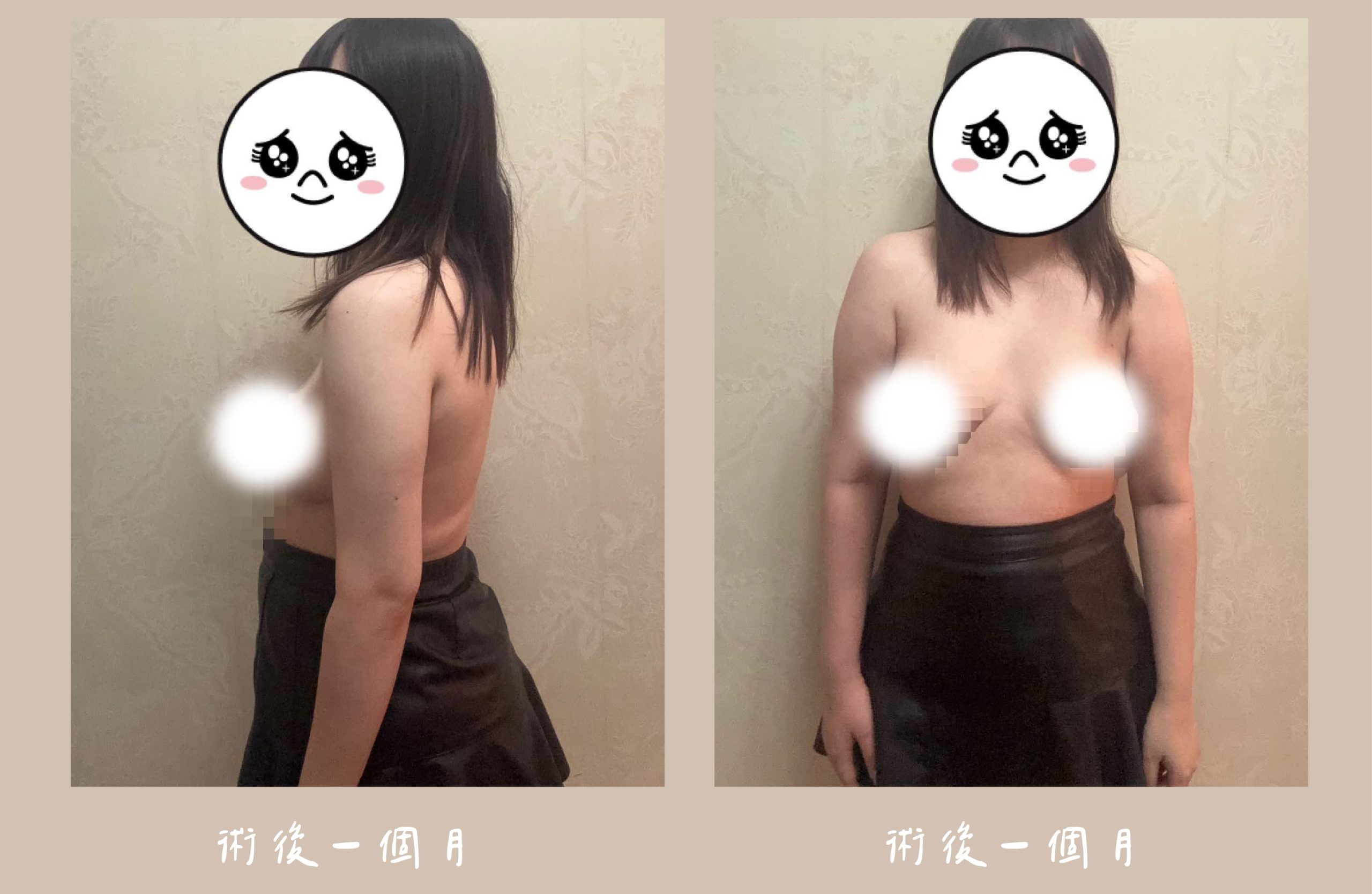 胡守丞院長-威塑2.2抽脂手臂環抽術後一個月