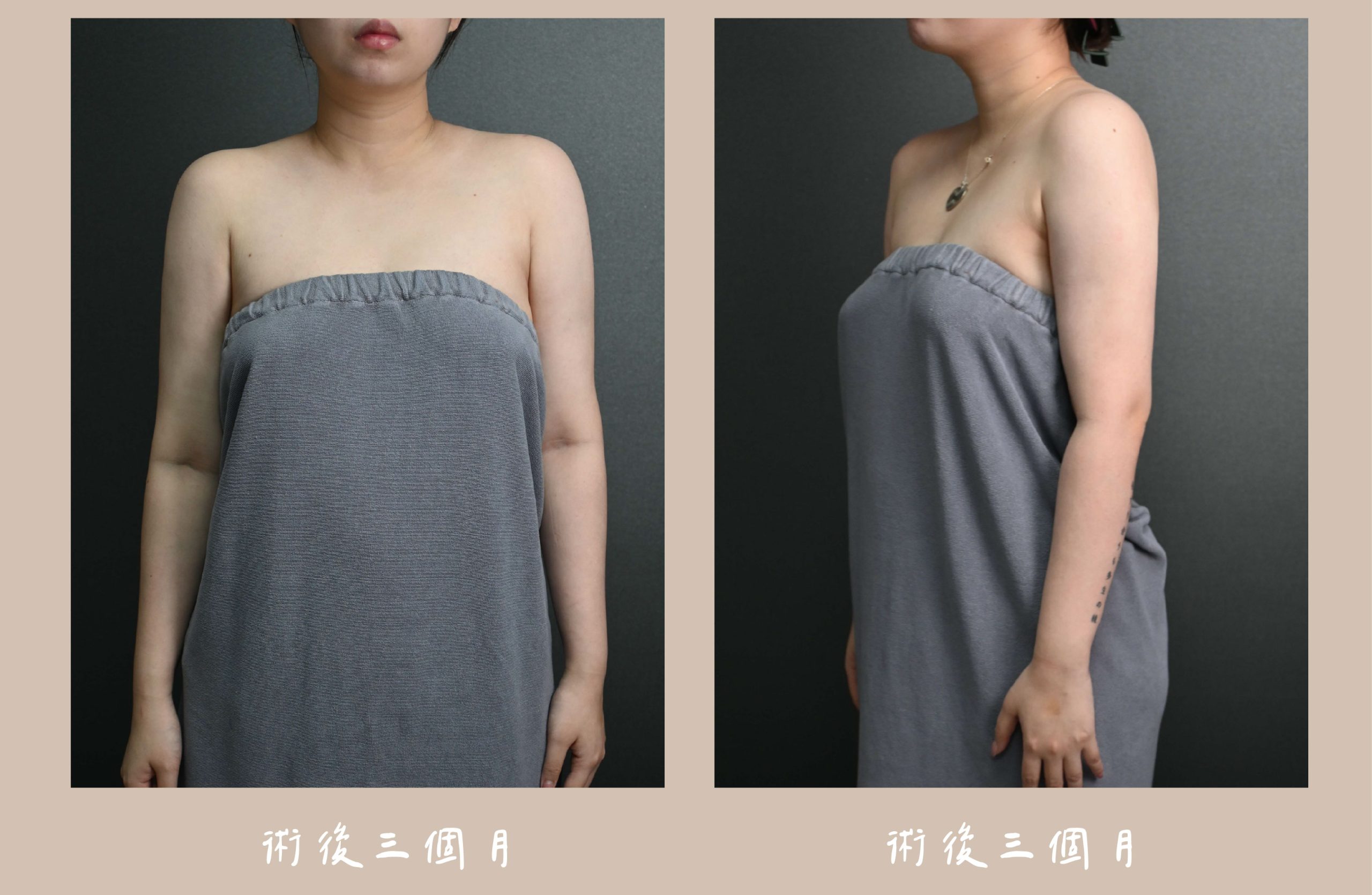 胡守丞院長-威塑2.2抽脂手臂環抽術後三個月