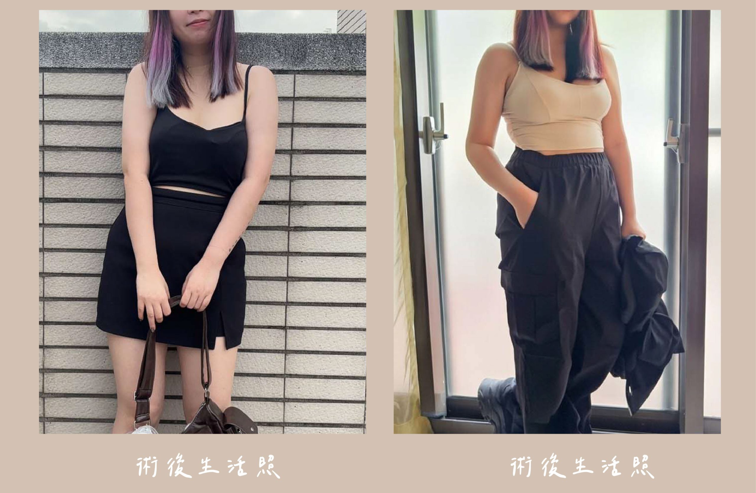 胡守丞院長-威塑2.2抽脂手臂環抽術後生活照