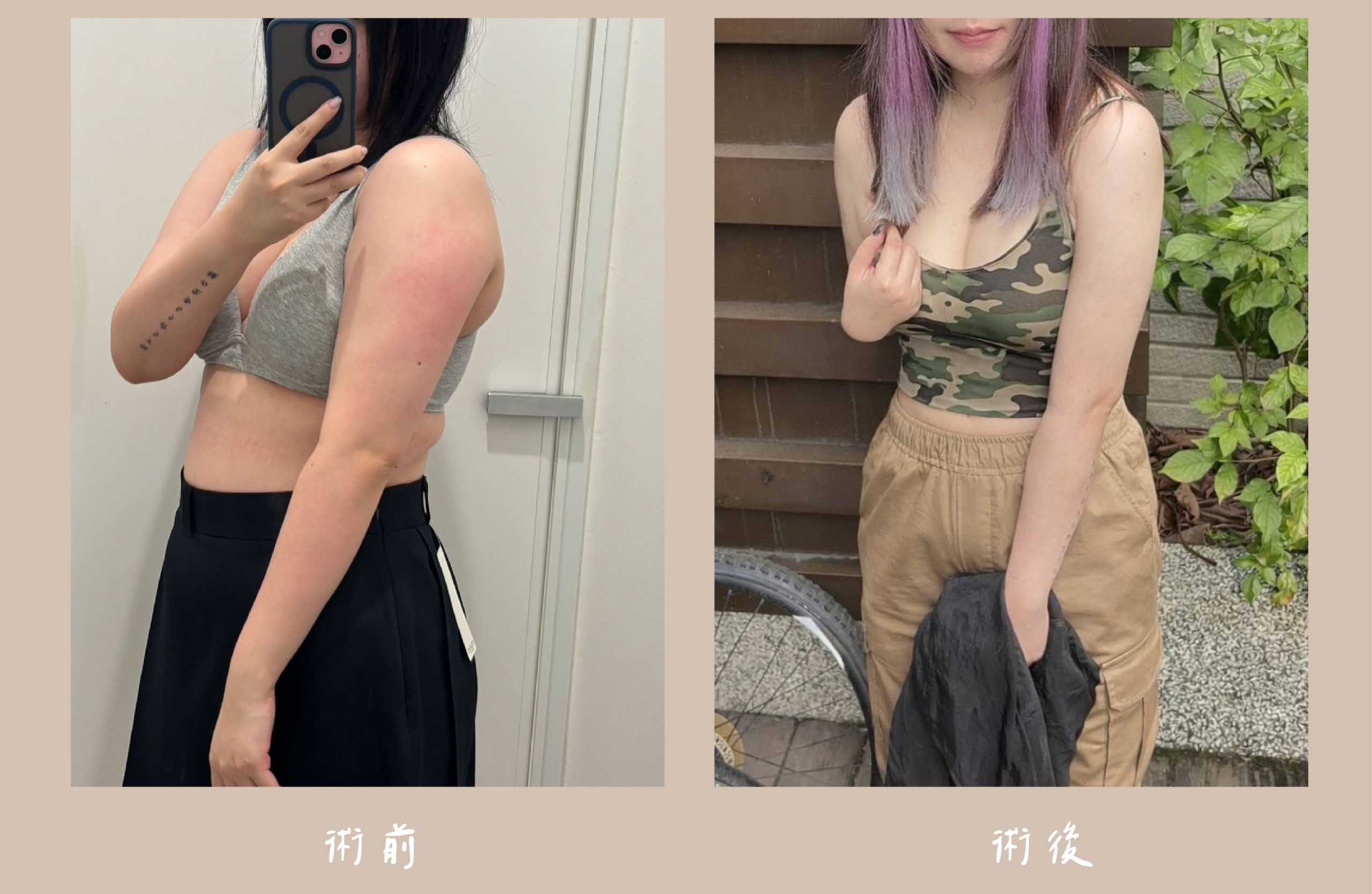 胡守丞院長-威塑2.2抽脂術前術後對比-手臂環抽案例-新顏診所