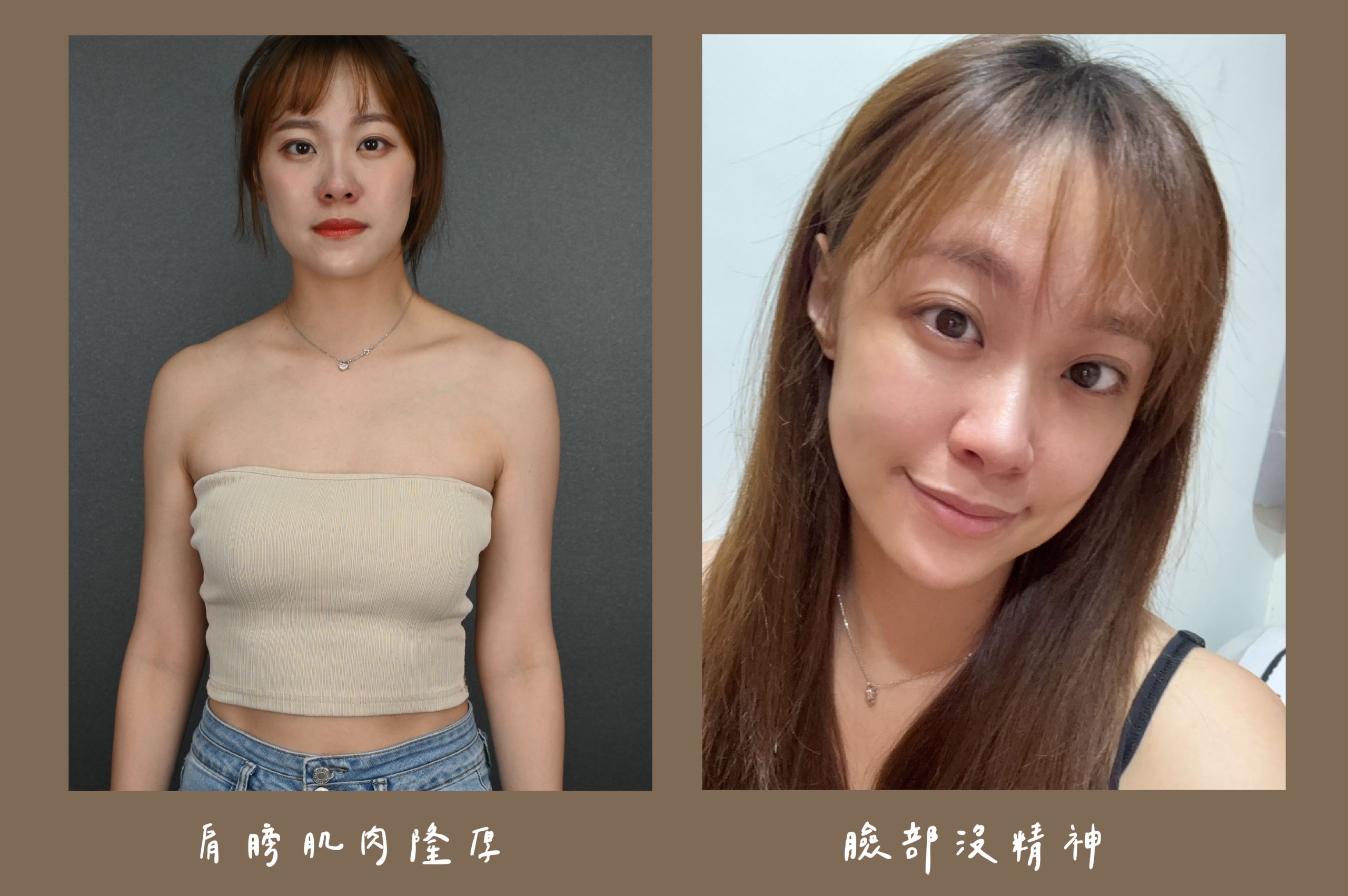 胡守丞醫師-薇貝拉-黑童&皇家肉毒_術前