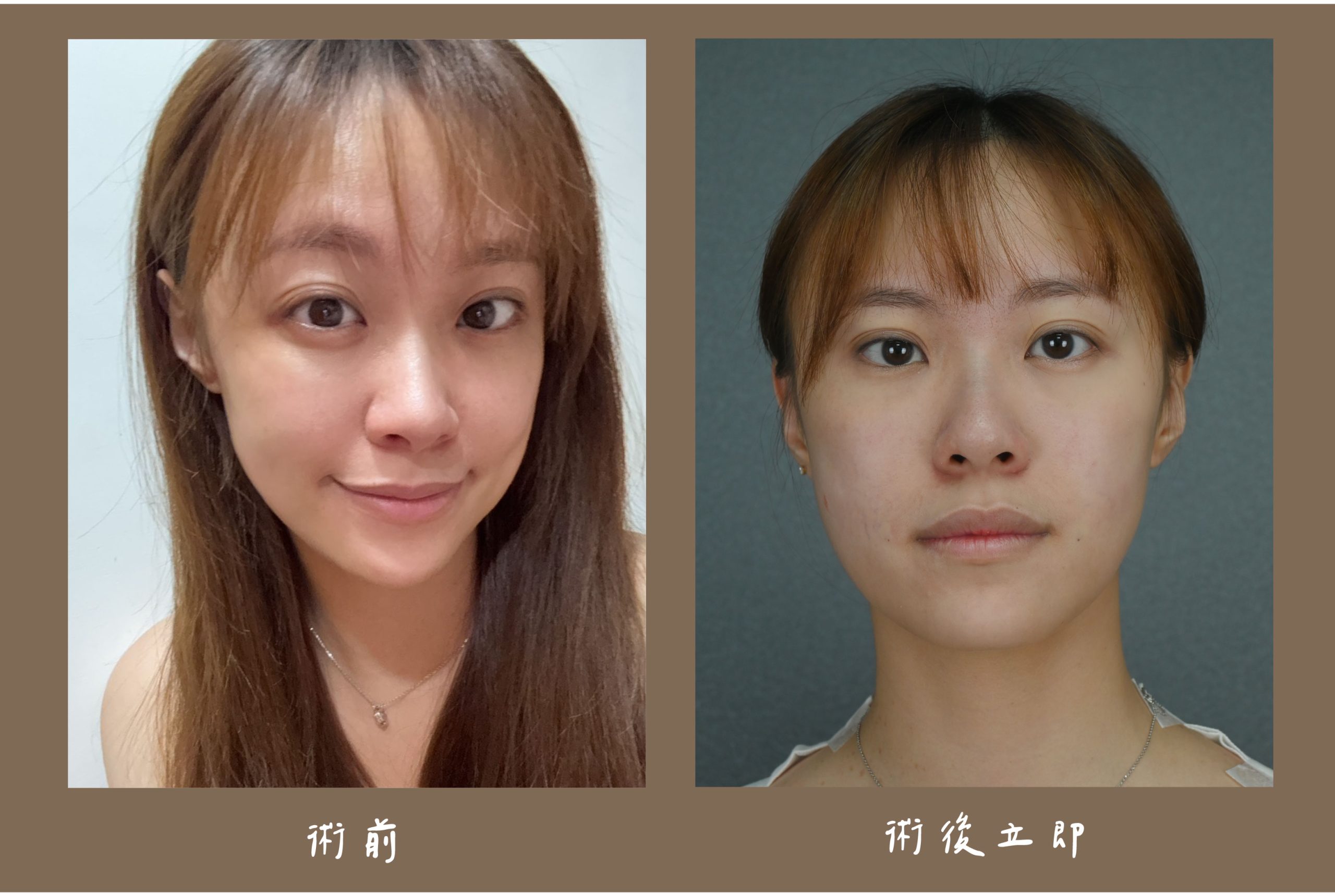 胡守丞醫師-薇貝拉-黑童&皇家肉毒_術後立即