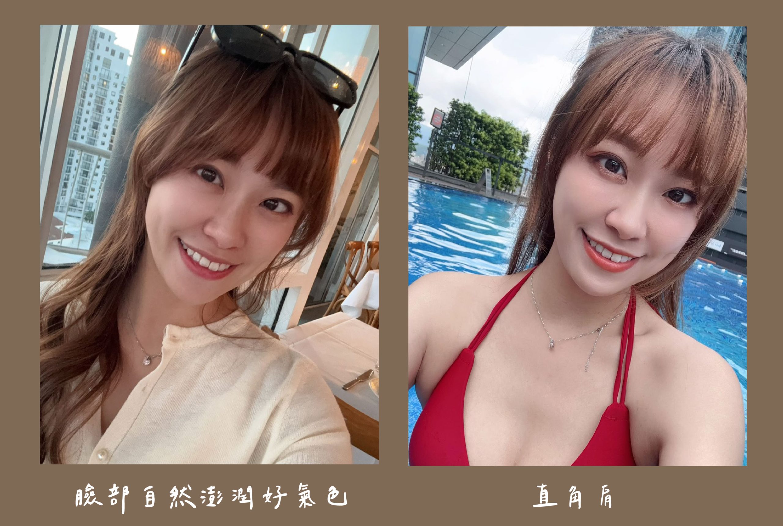 胡守丞醫師-薇貝拉-黑童&皇家肉毒_術後生活照