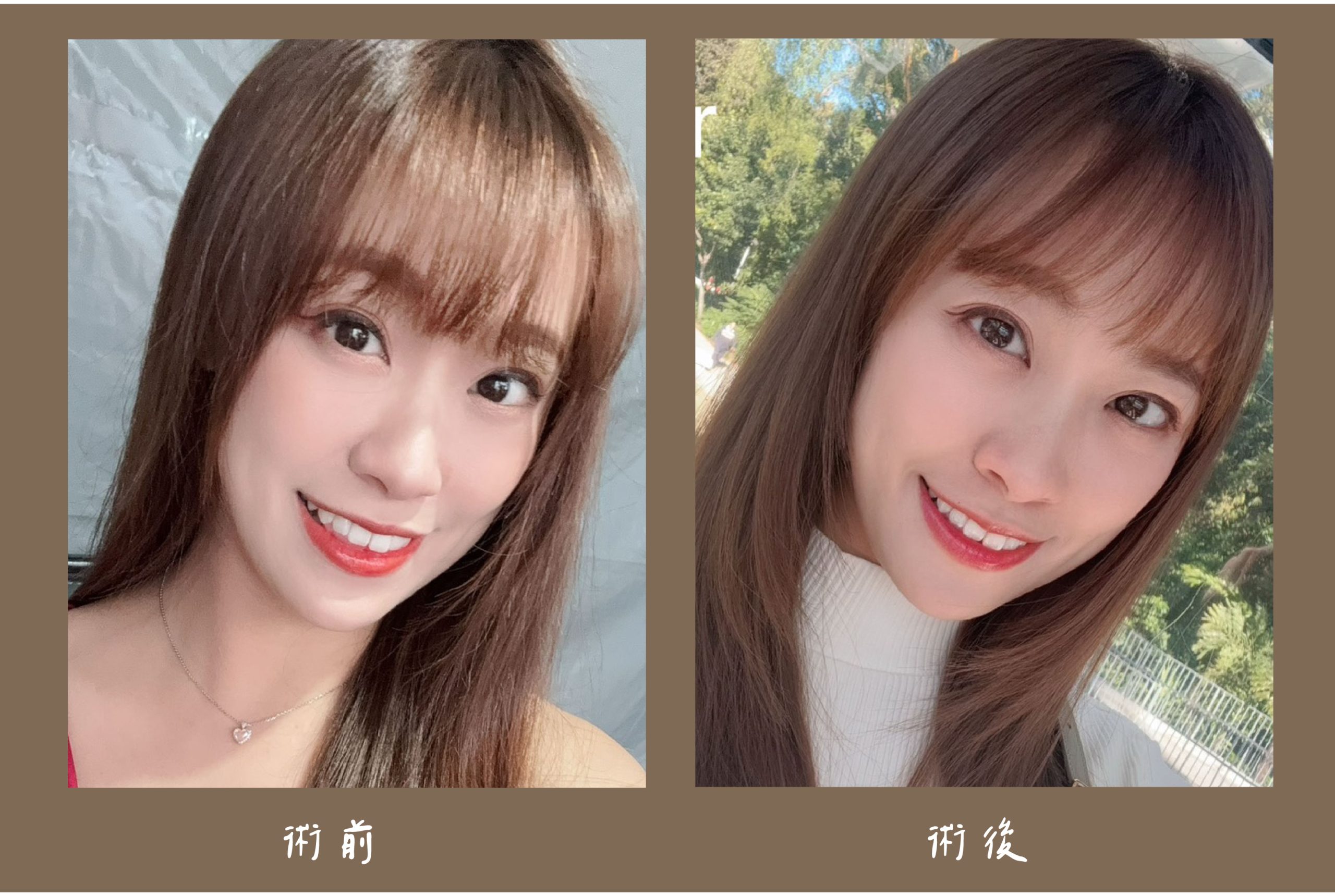 胡守丞院長-薇貝拉黑童&皇家肉毒術前術後對比