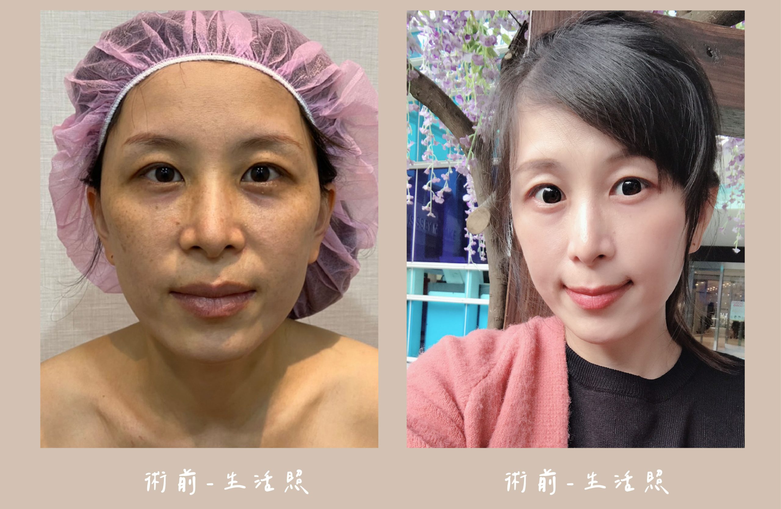 胡守丞醫師-臉部補脂術前生活照