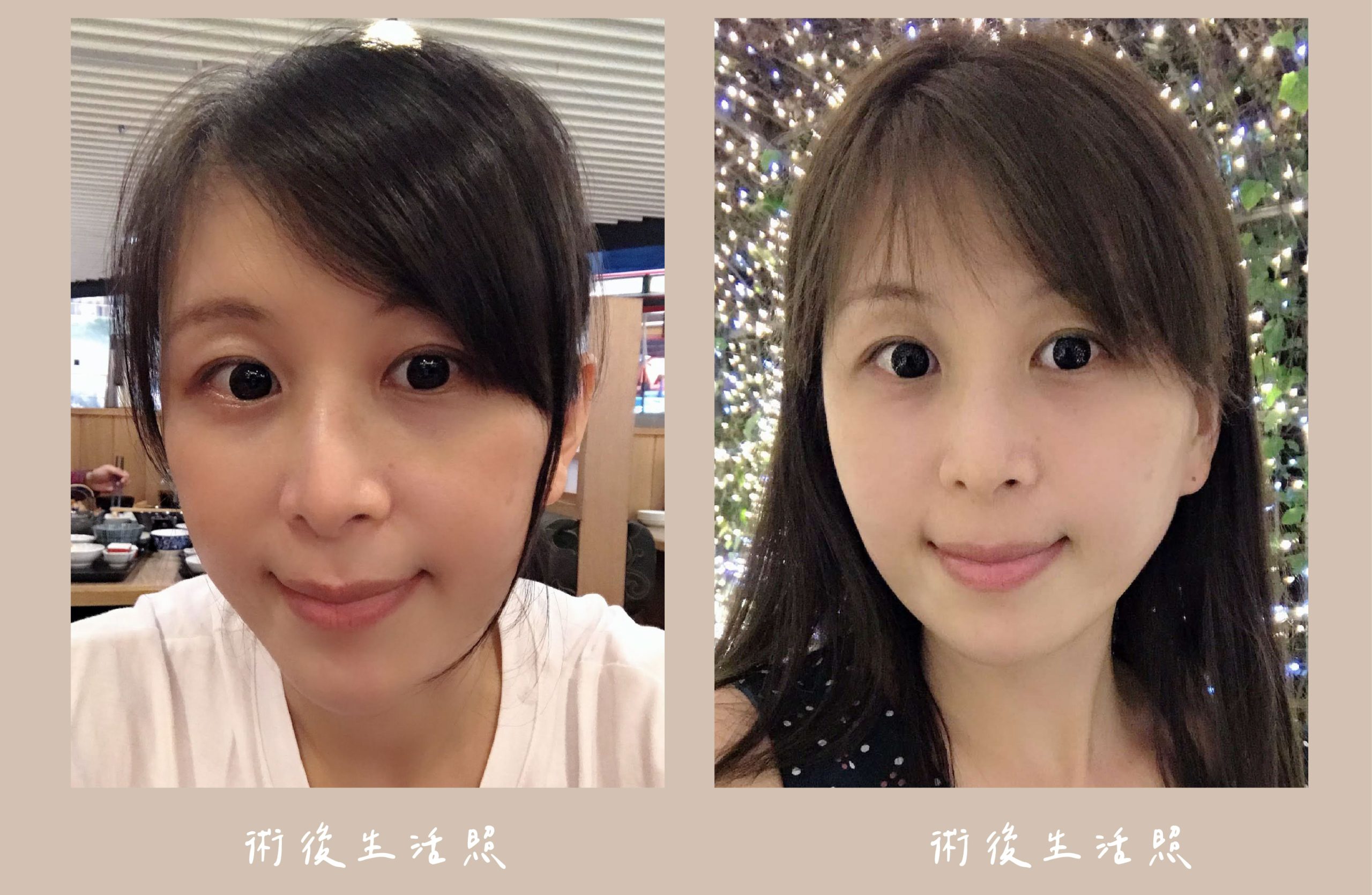 胡守丞醫師-臉部補脂術後生活照