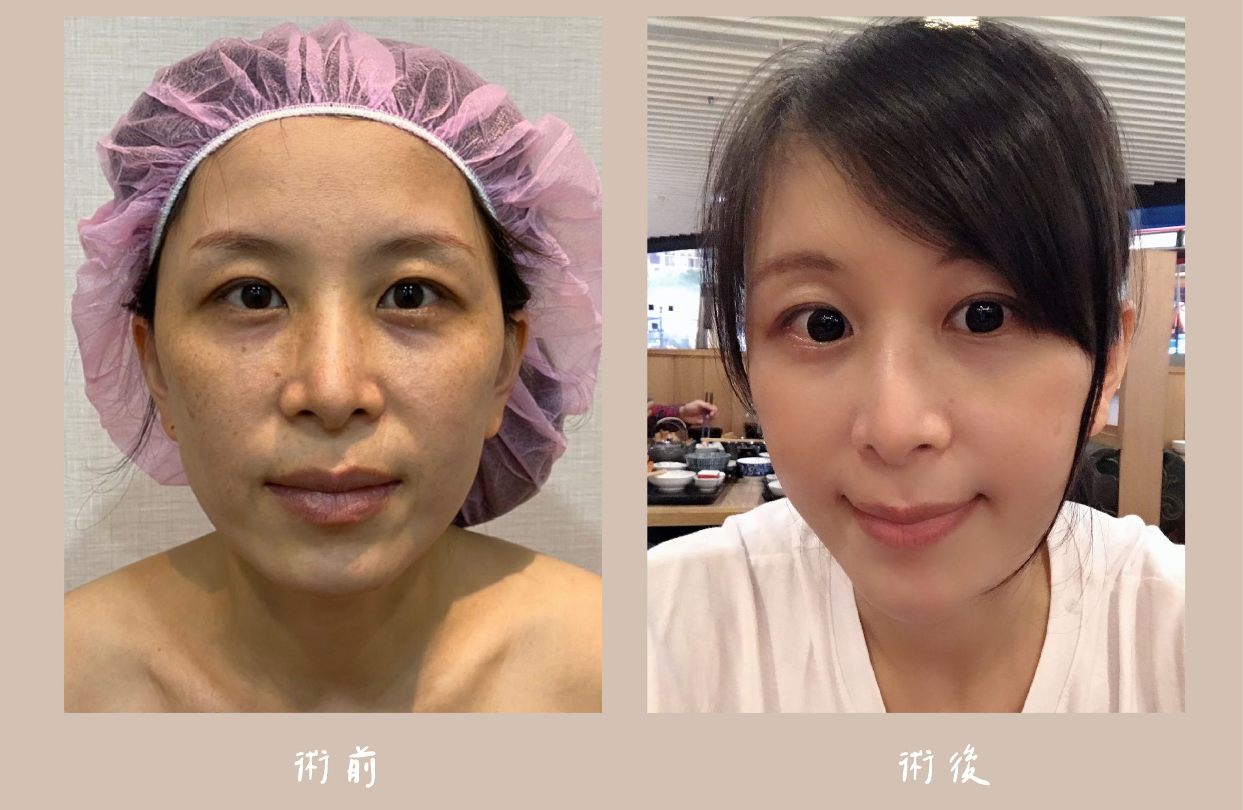 胡守丞醫師-臉部補脂_術前&術後