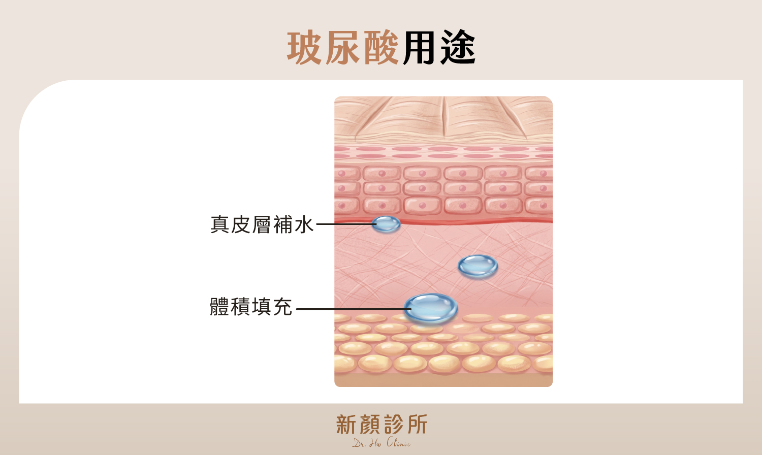 玻尿酸用途 真皮層補水 體積填充