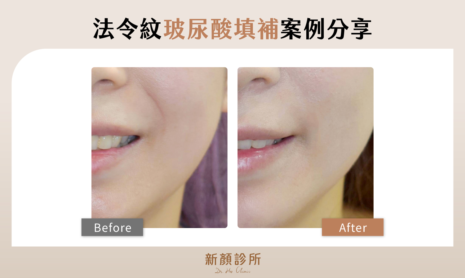 法令紋玻尿酸填補案例