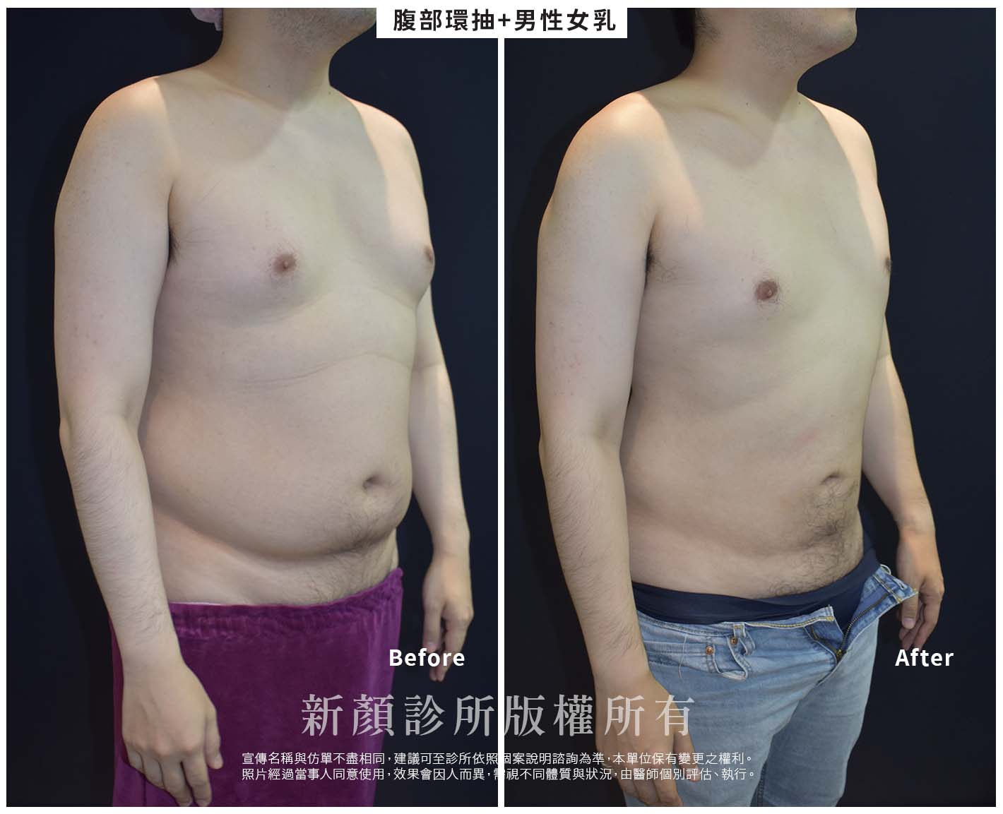 網頁BA -男性女乳症01