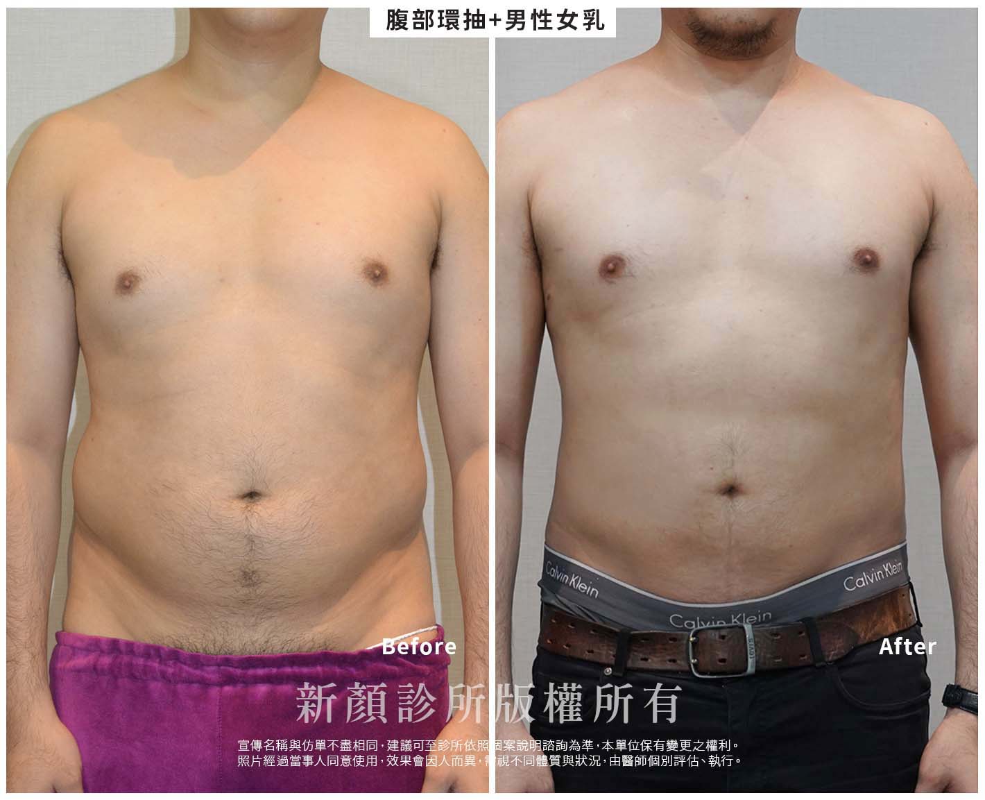網頁BA -男性女乳症02-1