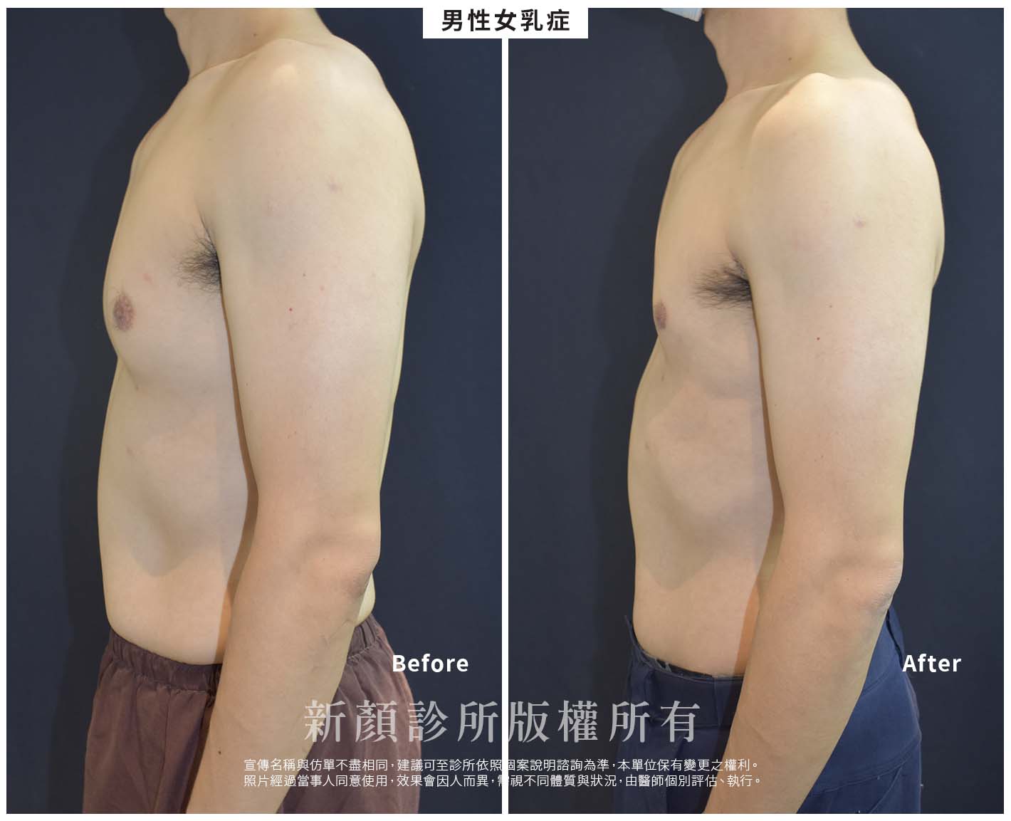 網頁BA -男性女乳症03