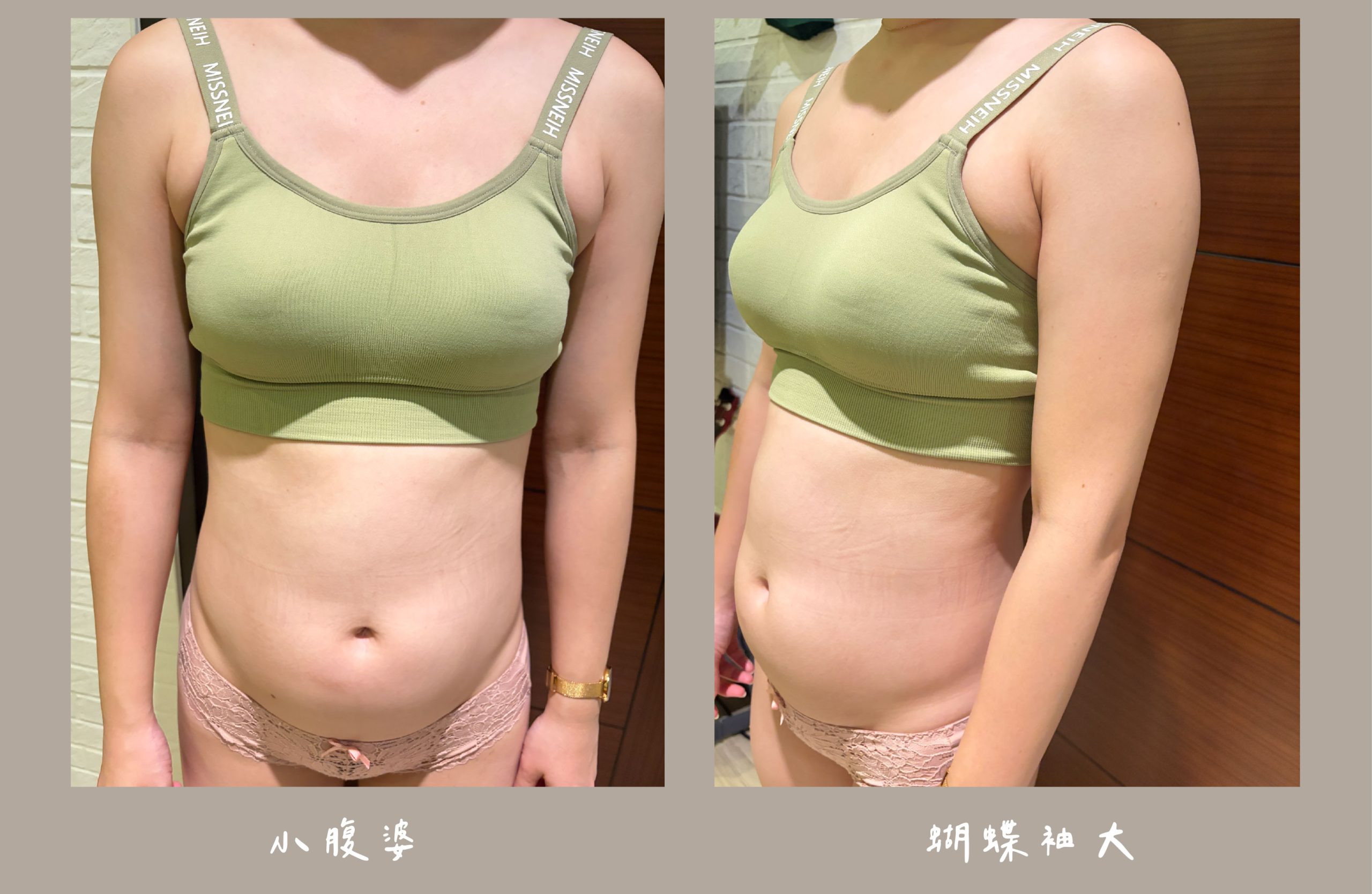 胡守丞院長-威塑2.2抽脂術前生活照