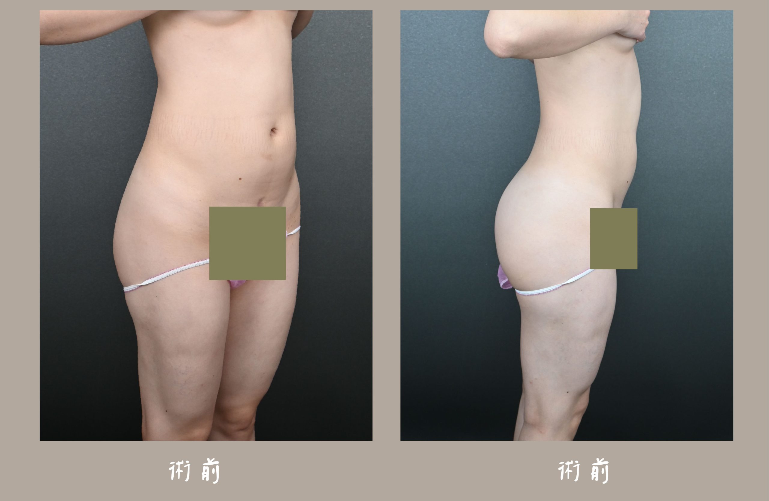 胡守丞院長-威塑2.2抽脂手臂環抽&腹部環抽術前