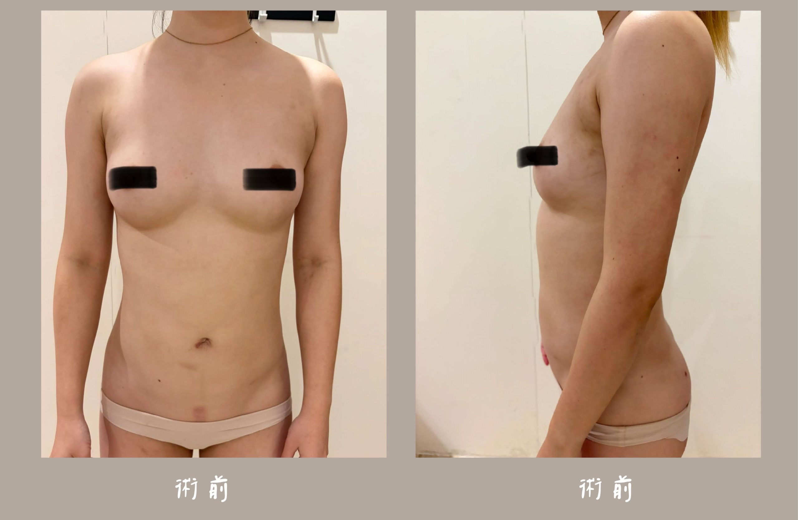 胡守丞院長-威塑2.2抽脂手臂+腹部環抽術後一個月