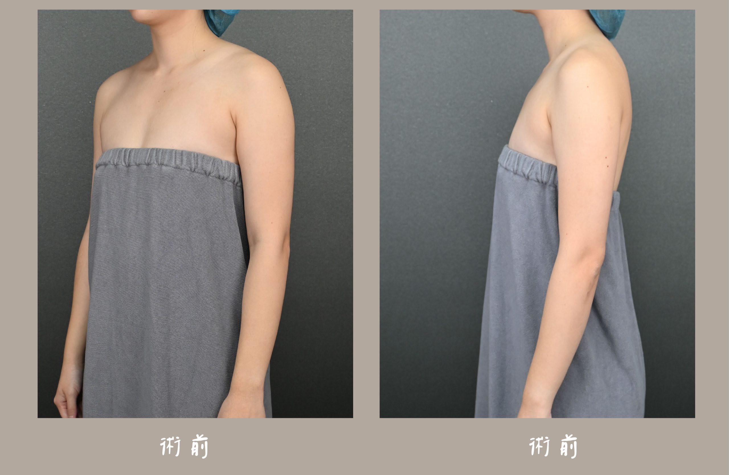 胡守丞院長-威塑2.2抽脂手臂環抽&腹部環抽術前