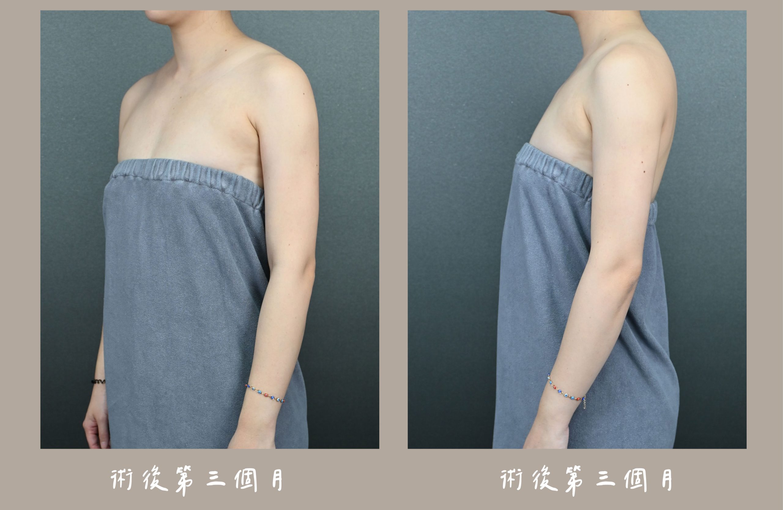 胡守丞院長-威塑2.2抽脂手臂+腹部環抽術後三個月