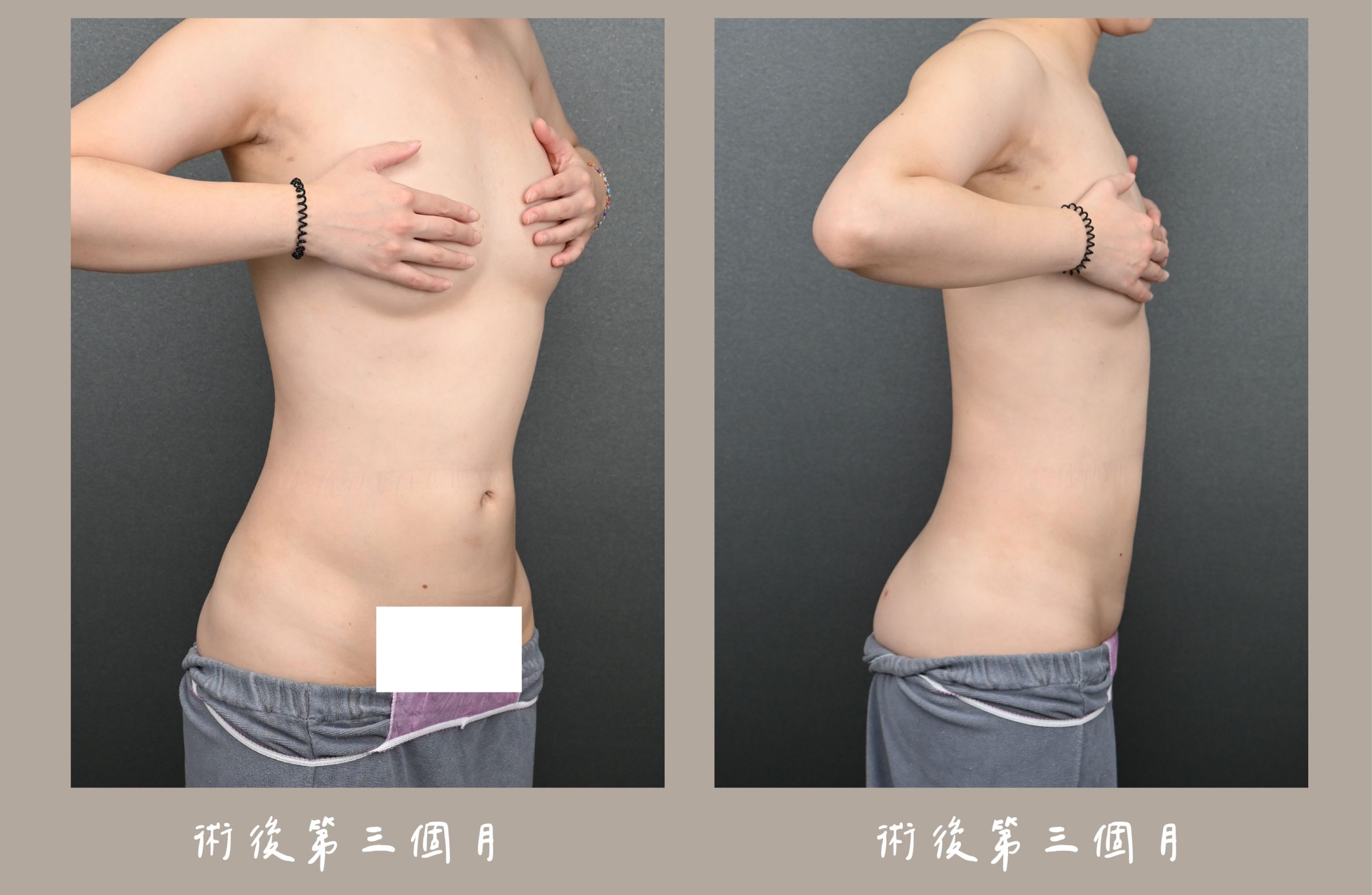 胡守丞院長-威塑2.2抽脂手臂+腹部環抽術後三個月