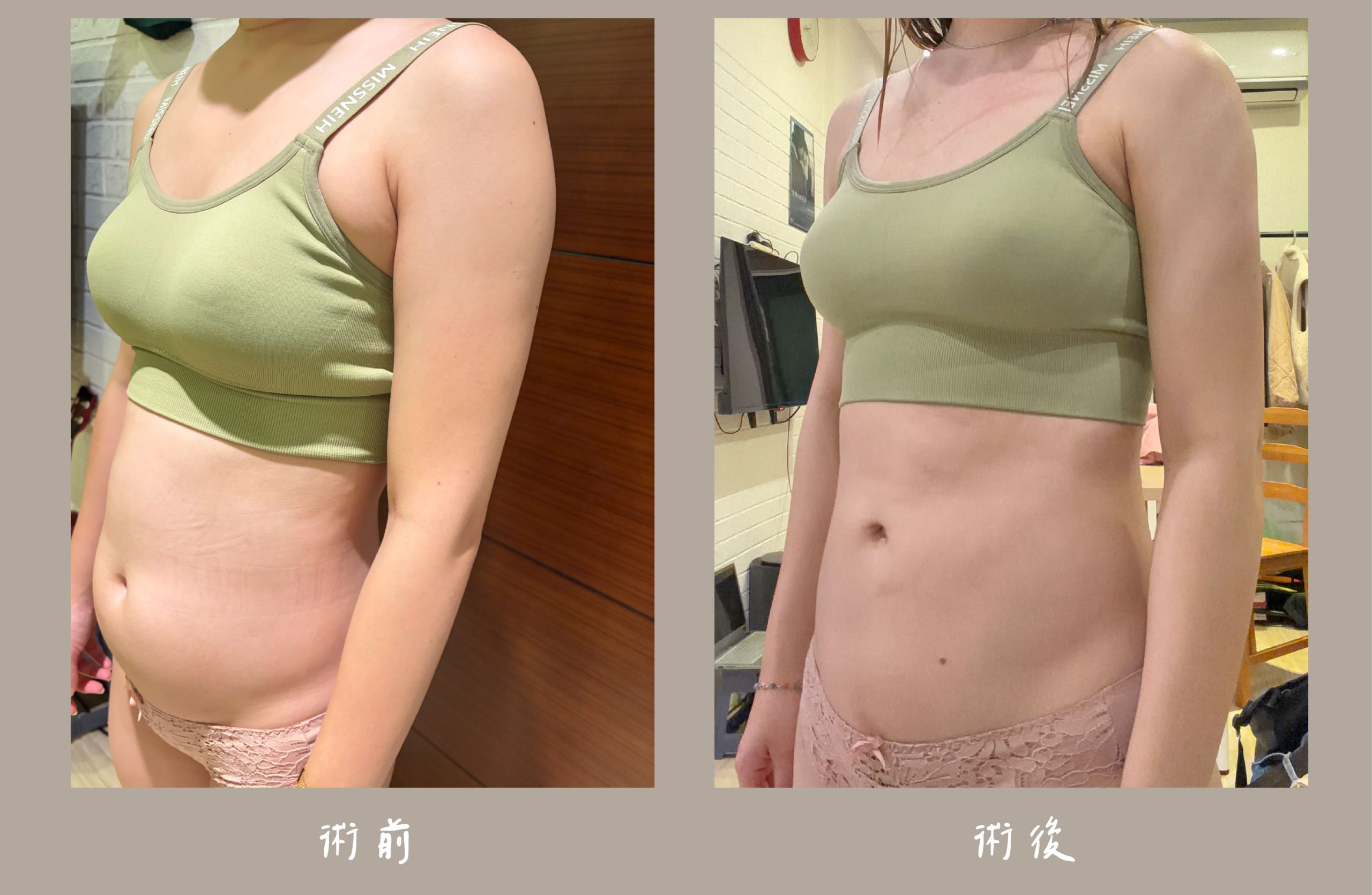 胡守丞院長-威塑2.2抽脂術前術後對比-手臂+腹部環抽案例-新顏診所