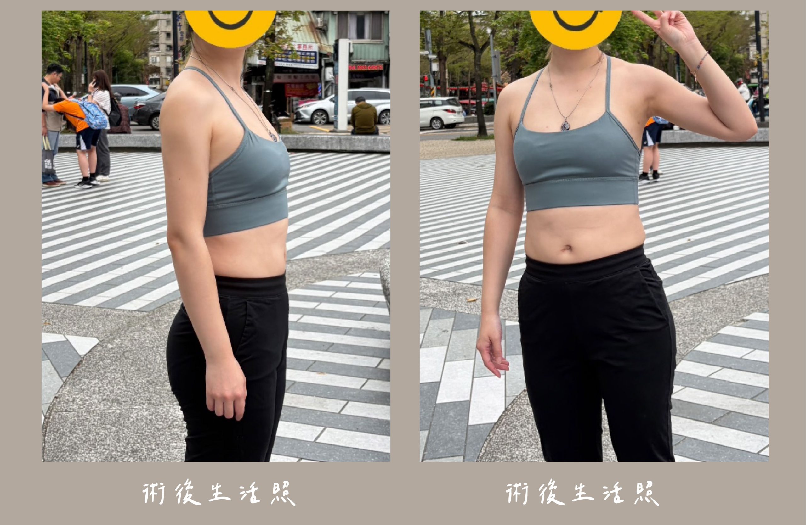 胡守丞院長-威塑2.2抽脂手臂+腹部環抽術後生活照