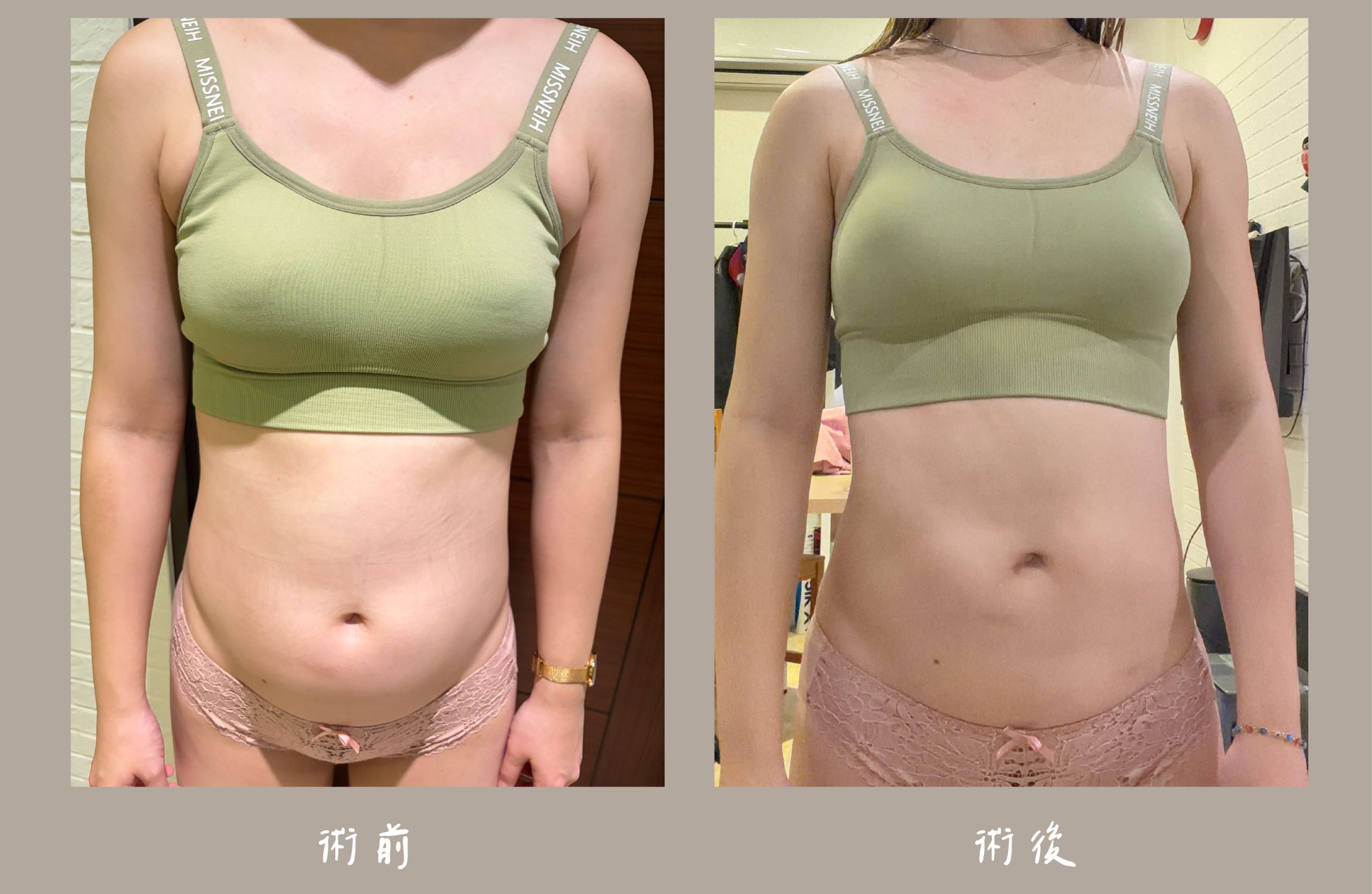 胡守丞院長-威塑2.2抽脂術前術後對比-手臂+腹部環抽案例-新顏診所