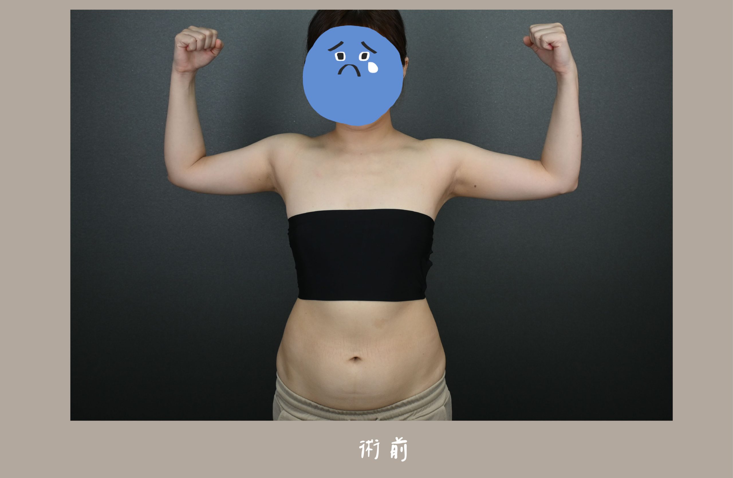 胡守丞院長-威塑2.2抽脂手臂環抽&腹部環抽術前