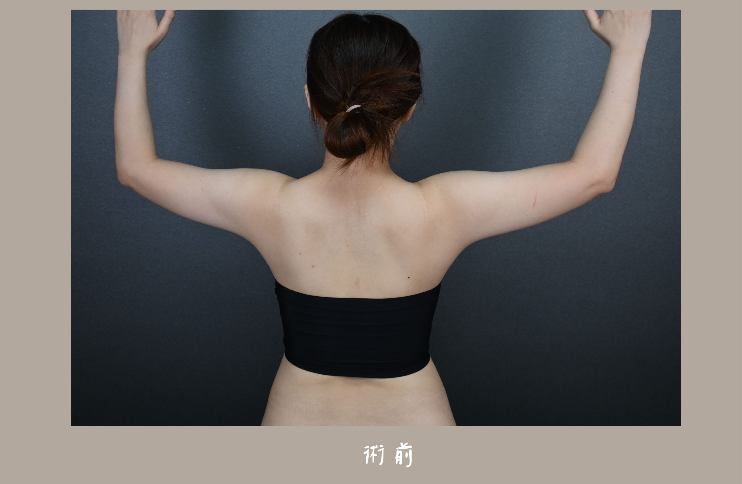 胡守丞院長-威塑2.2抽脂手臂環抽&腹部環抽術前