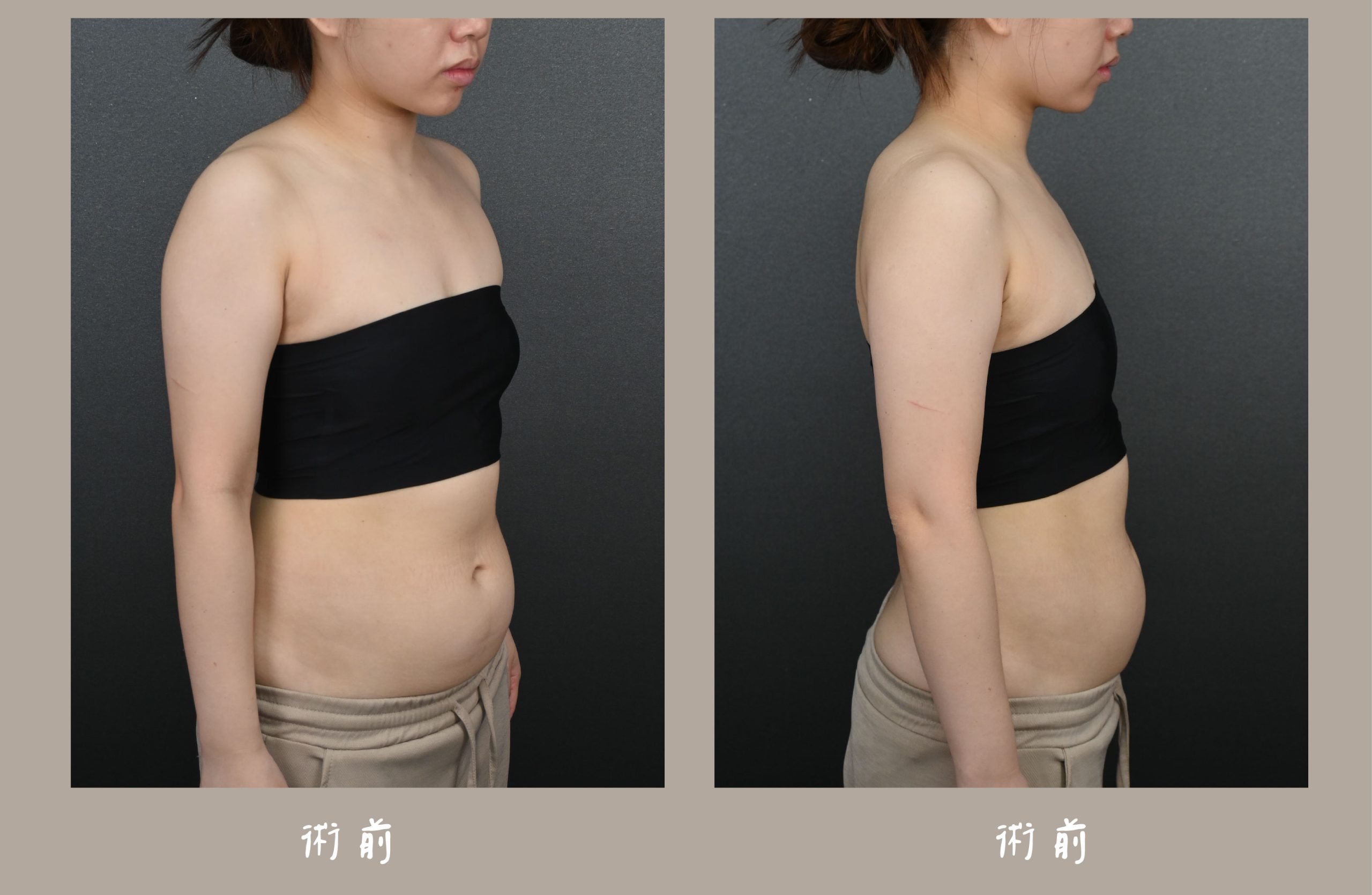 胡守丞院長-威塑2.2抽脂手臂環抽&腹部環抽術前