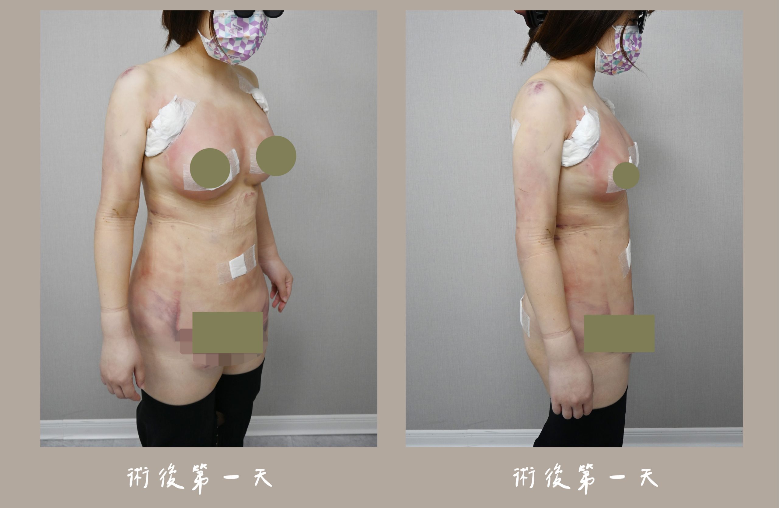 胡守丞院長-威塑2.2抽脂手臂+腹部環抽術後隔天