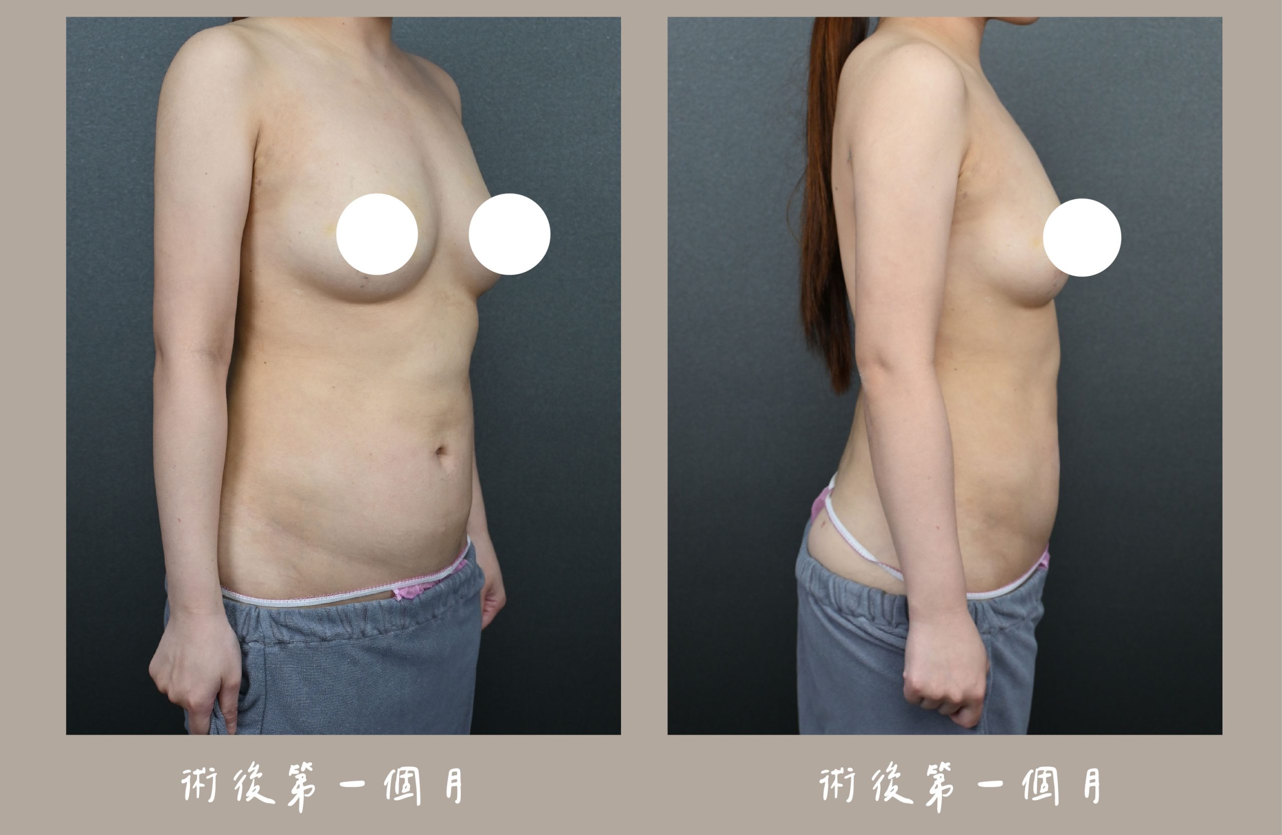 胡守丞院長-威塑2.2抽脂手臂+腹部環抽術後一個月