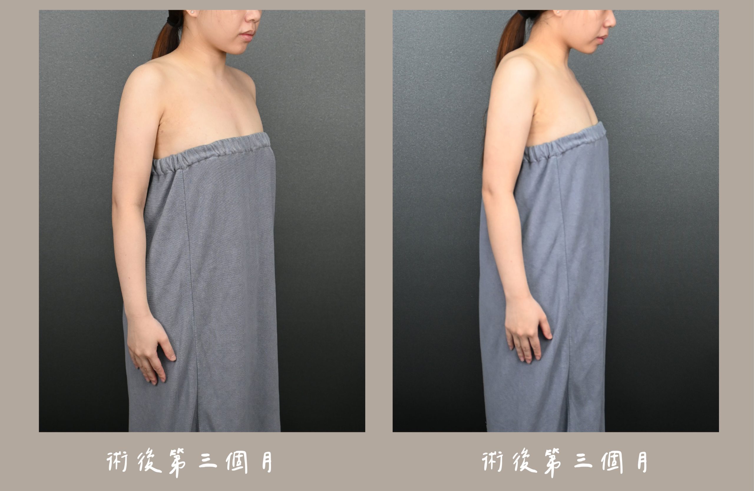 胡守丞院長-威塑2.2抽脂手臂+腹部環抽術後三個月